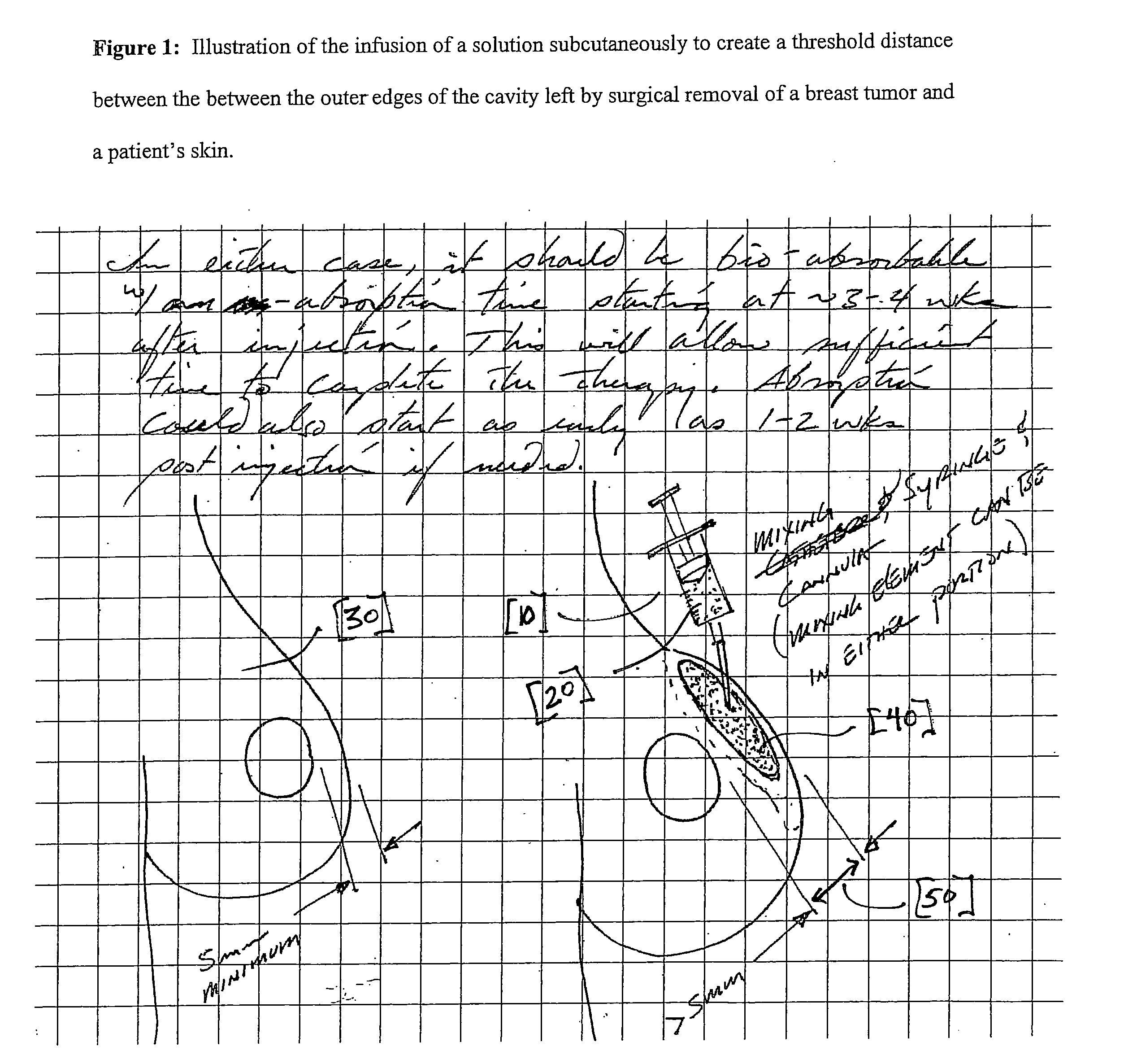 Tumescent skin spacing method