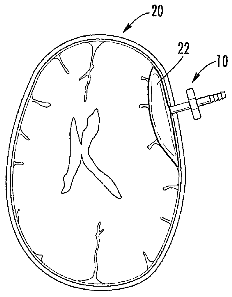 Subdural drainage catheters with self contained mechanism for restoration of flow following catheter obstruction