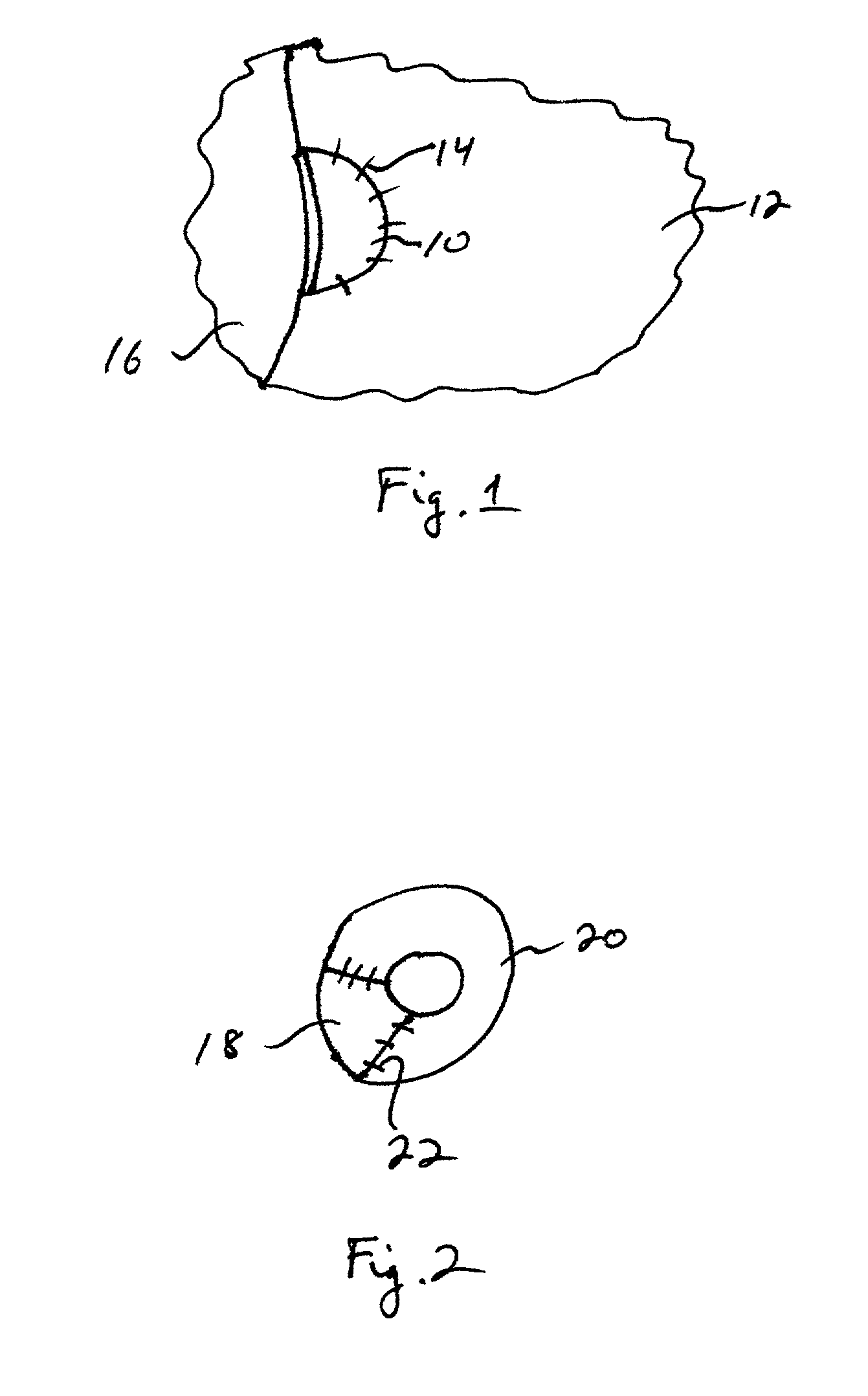 Resorbable extracellular matrix for reconstruction of cartilage