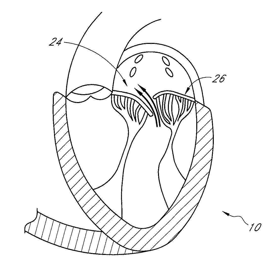 Transvalvular intraannular band and chordae cutting for ischemic and dilated cardiomyopathy