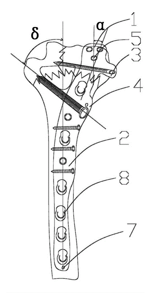 Humeral far-end posterior-lateral double-column fixing and locking bone fixation plate