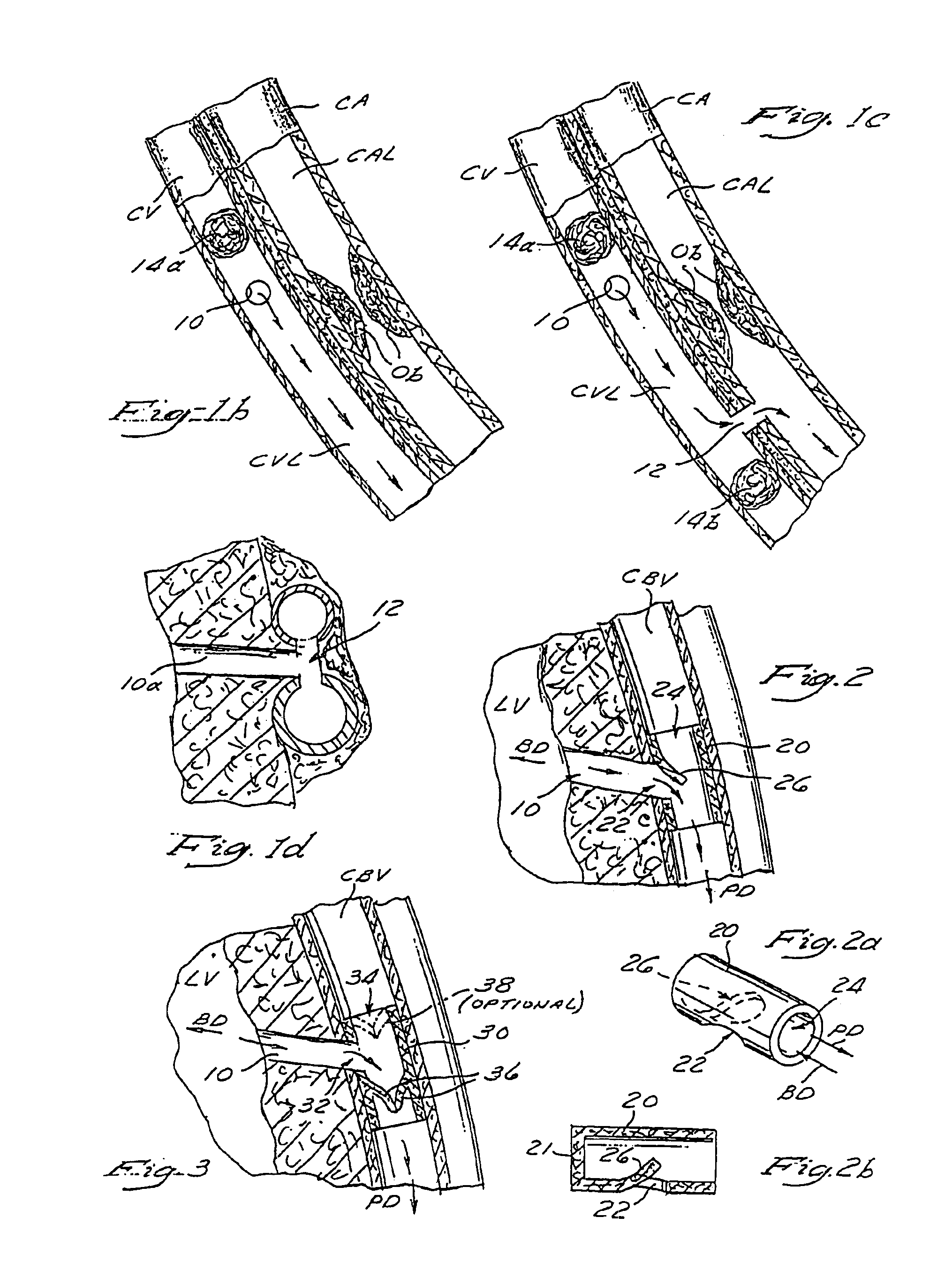 Method and apparatus for transmyocardial direct coronary revascularization