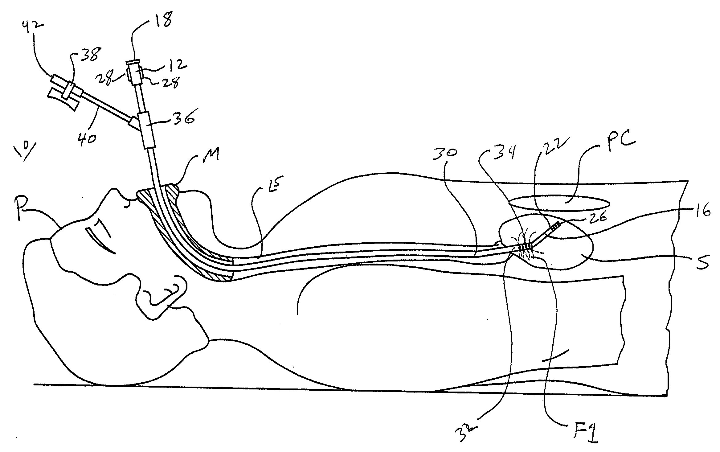 Dual lumen catheter and method for minimally invasive endoluminal surgery