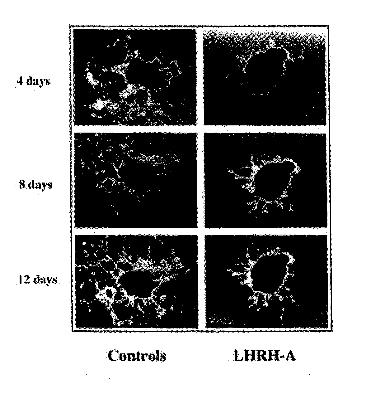 Methods for reducing gnrh-positive tumor cell proliferation