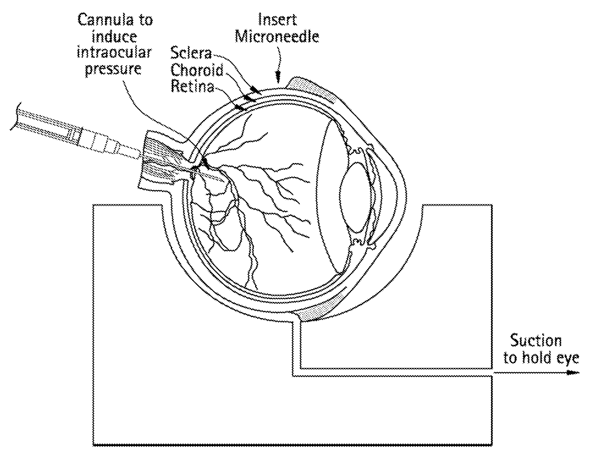 Methods and Devices for Drug Delivery to Ocular Tissue Using Microneedle