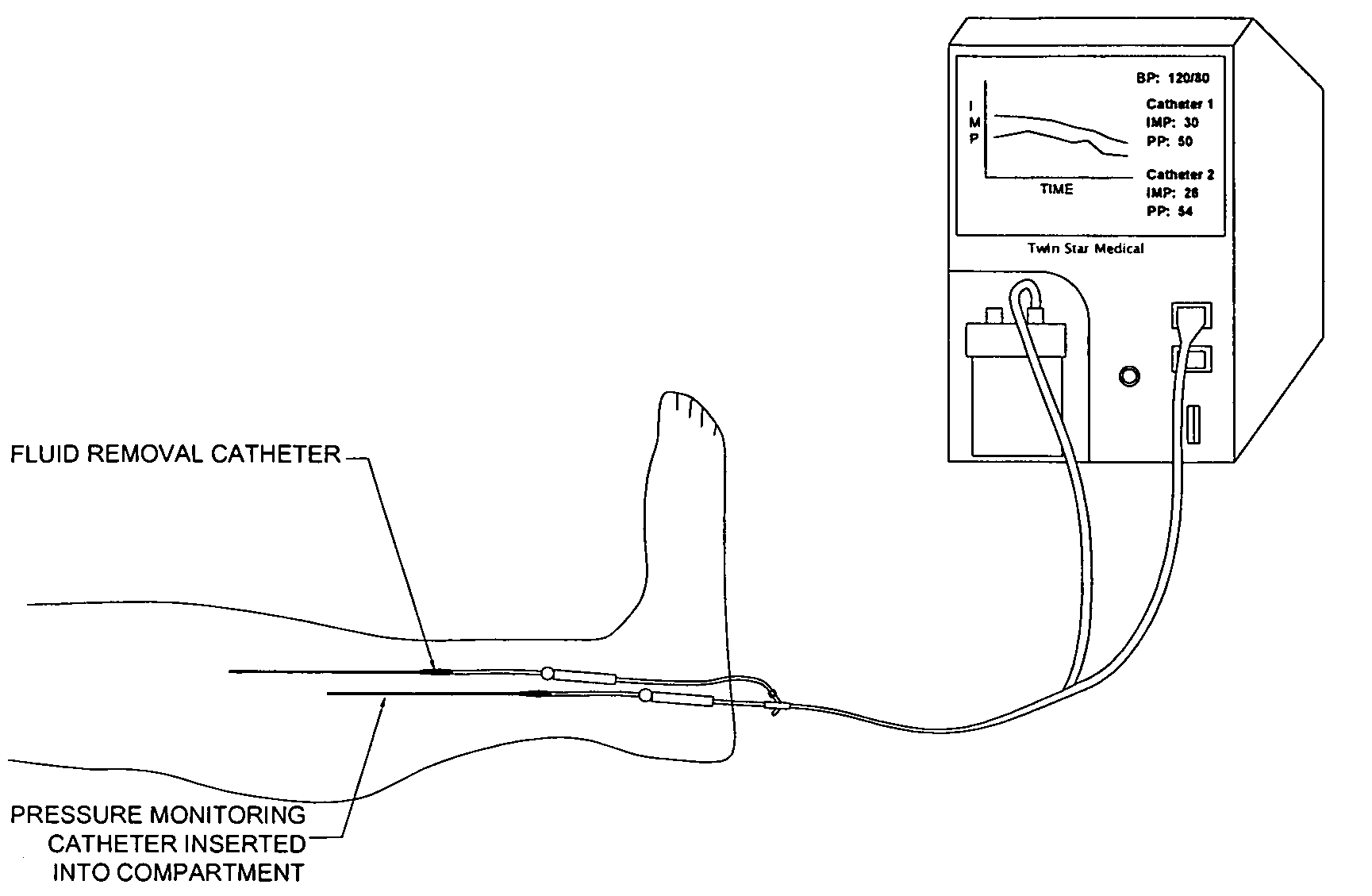 Assay catheter with pressure monitoring