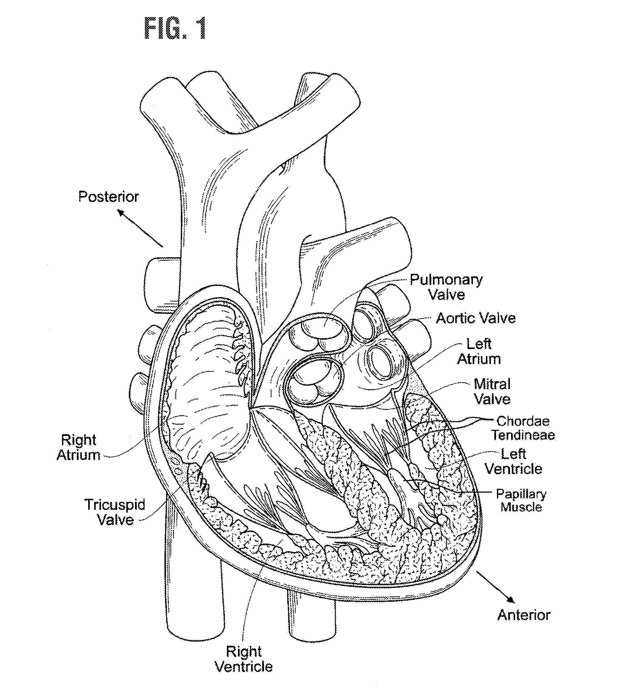 Rapidly deployable surgical heart valves