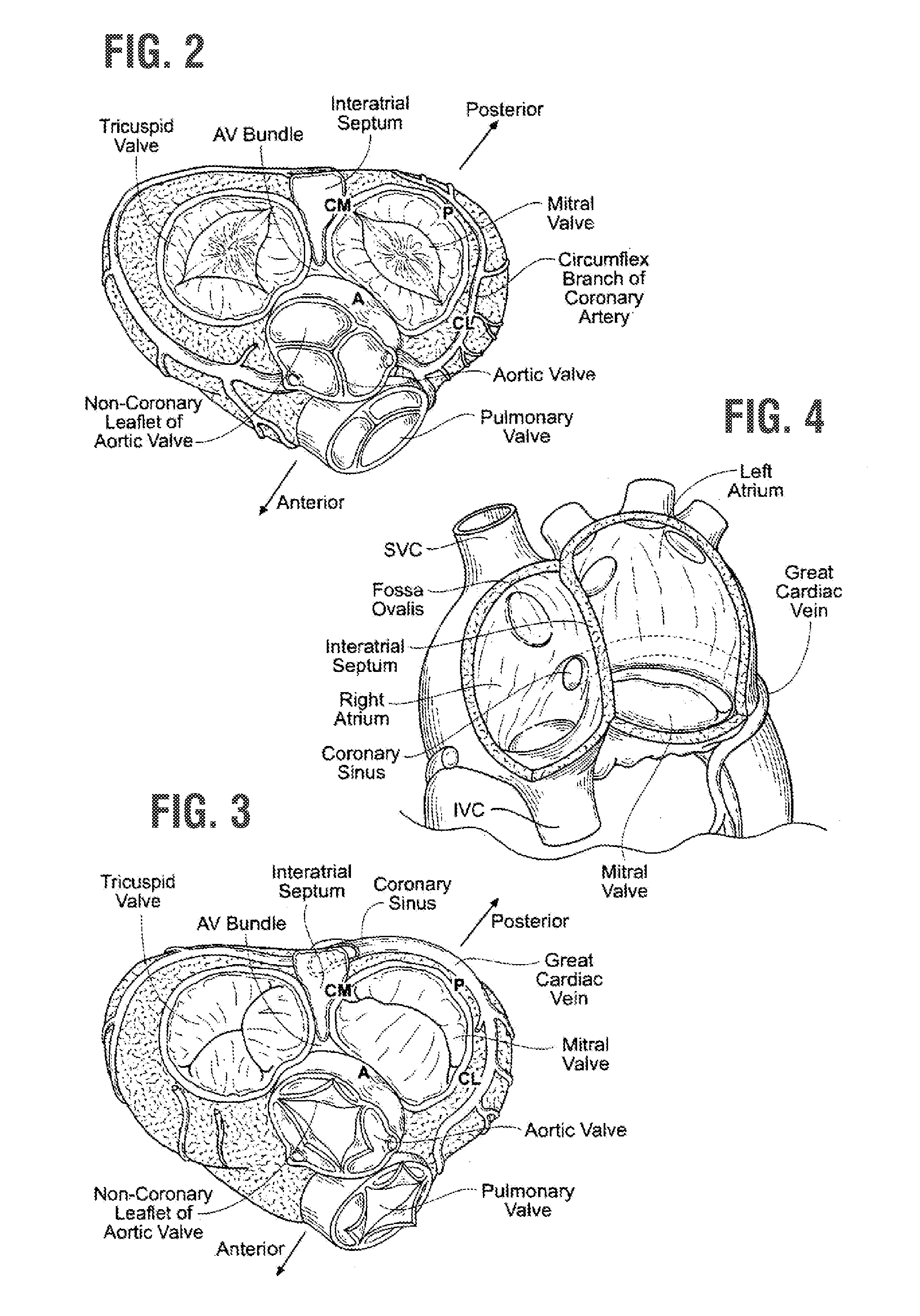 Rapidly deployable surgical heart valves