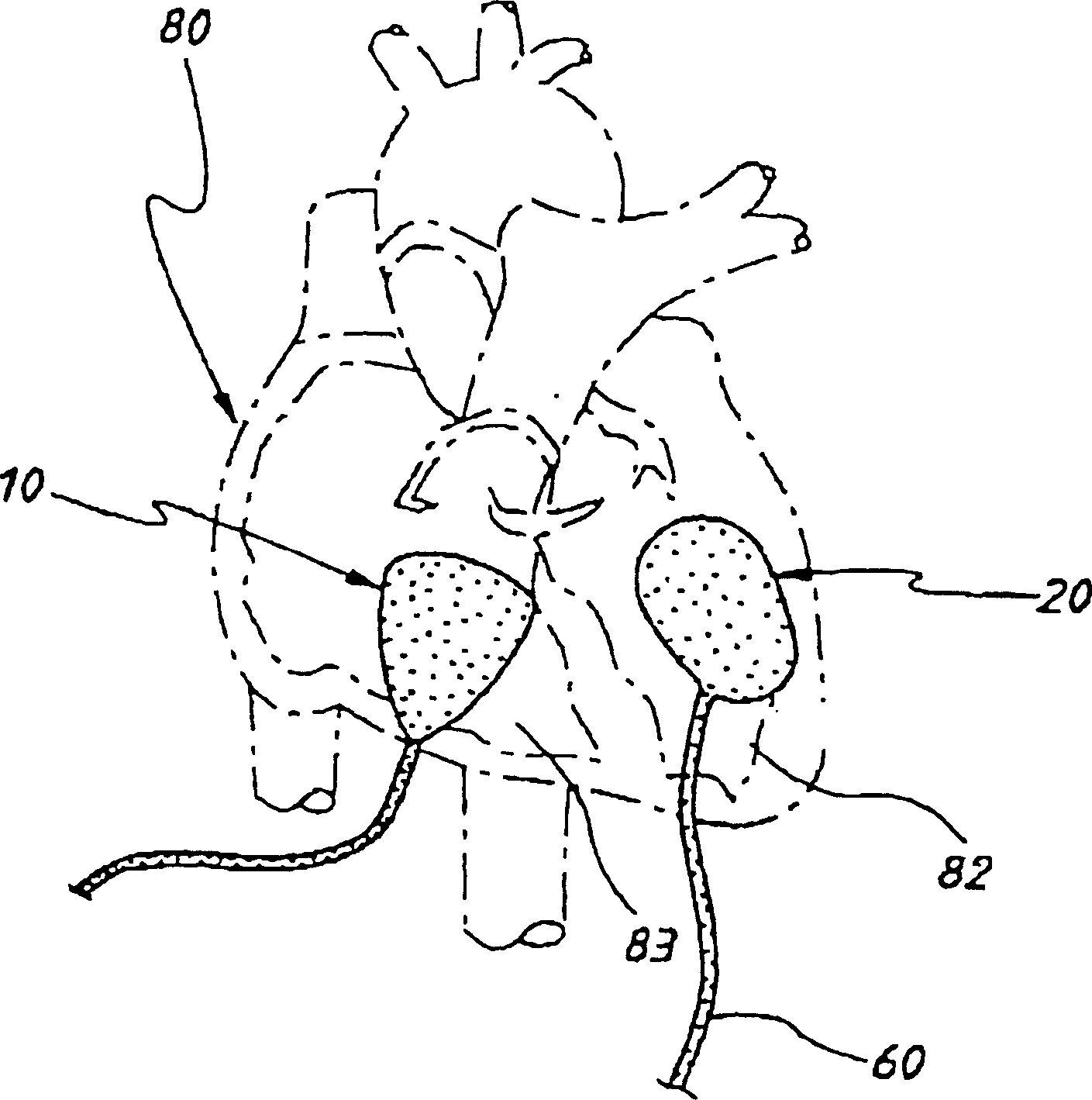 Assist device for failing heart