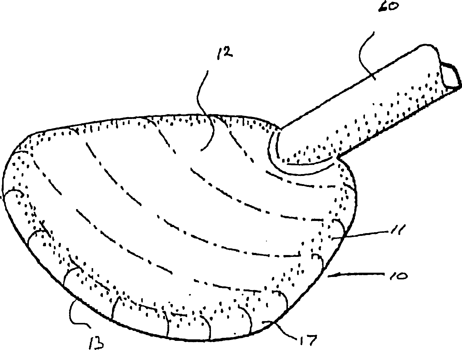 Assist device for failing heart