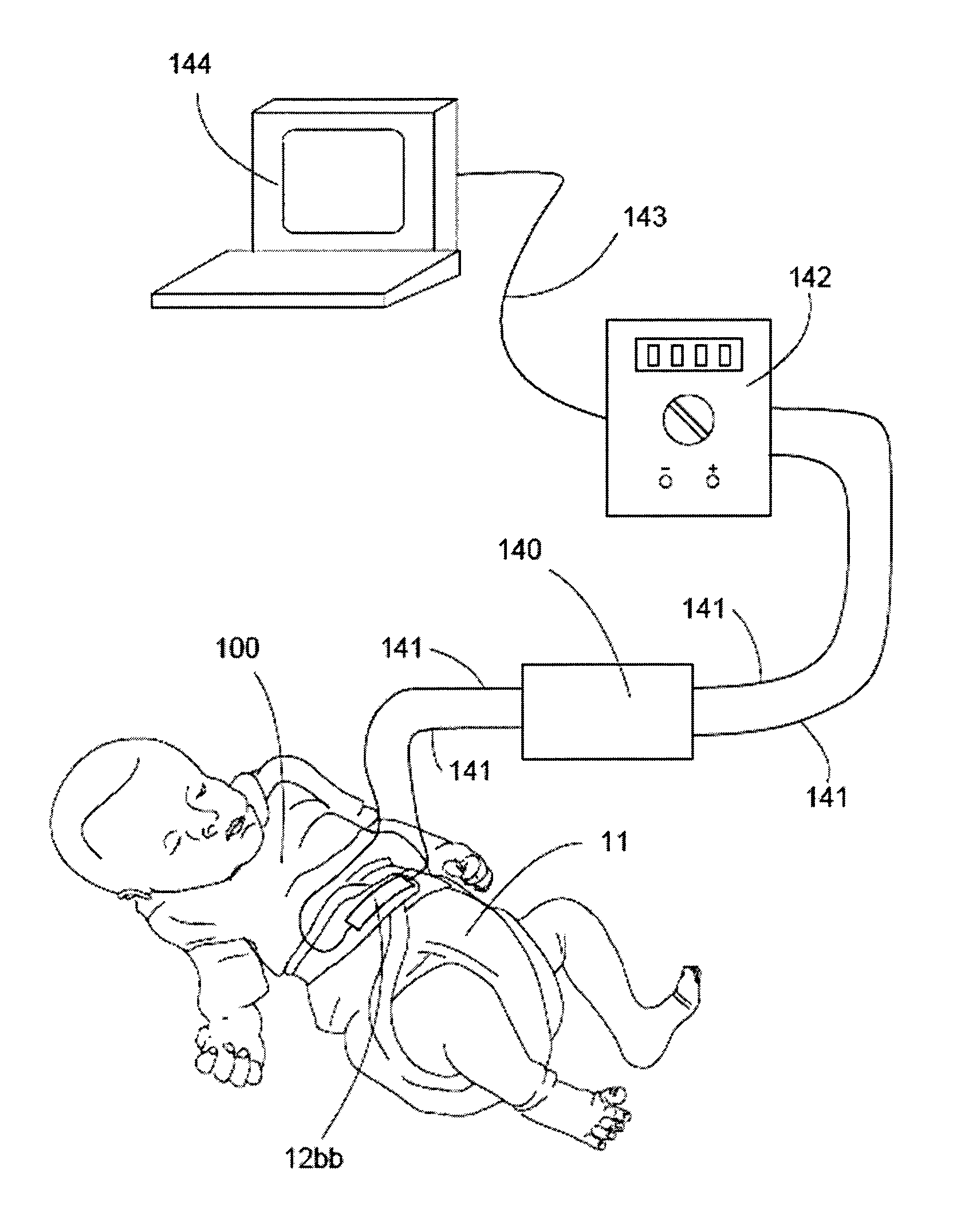 Monitoring physiological condition of a subject