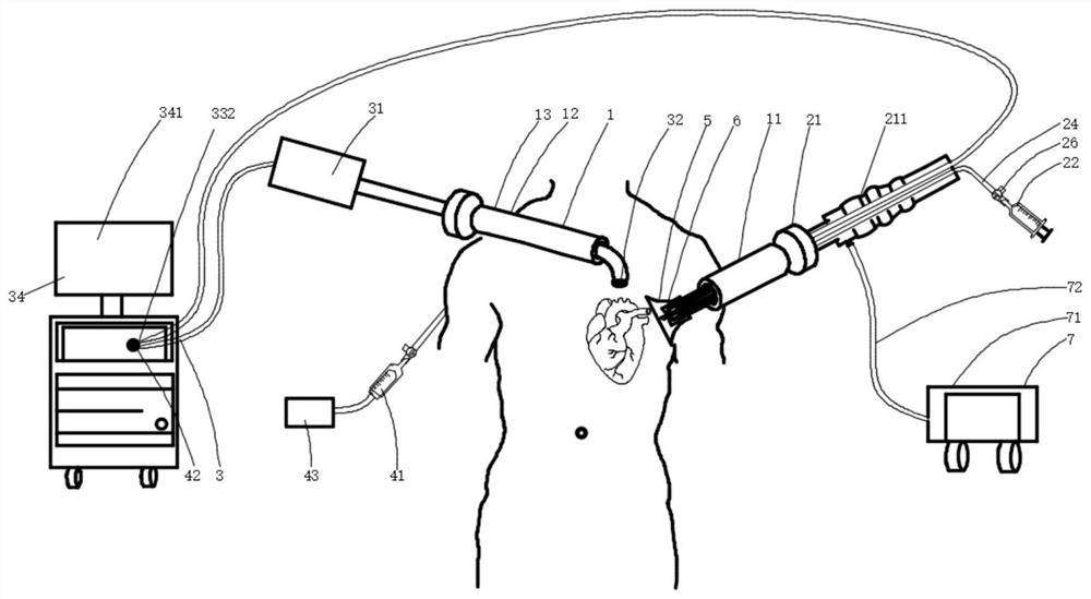 Thoracoscopic heart failure treatment system