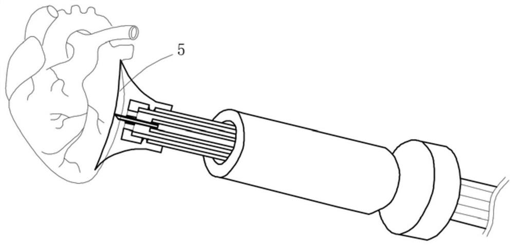 Thoracoscopic heart failure treatment system