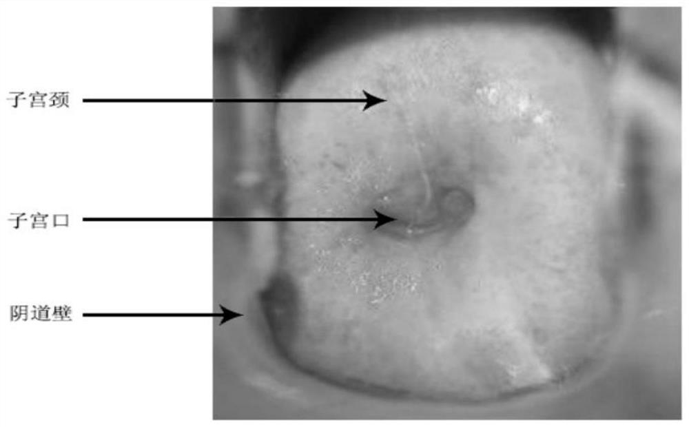 Image processing method and system in electronic colposcope