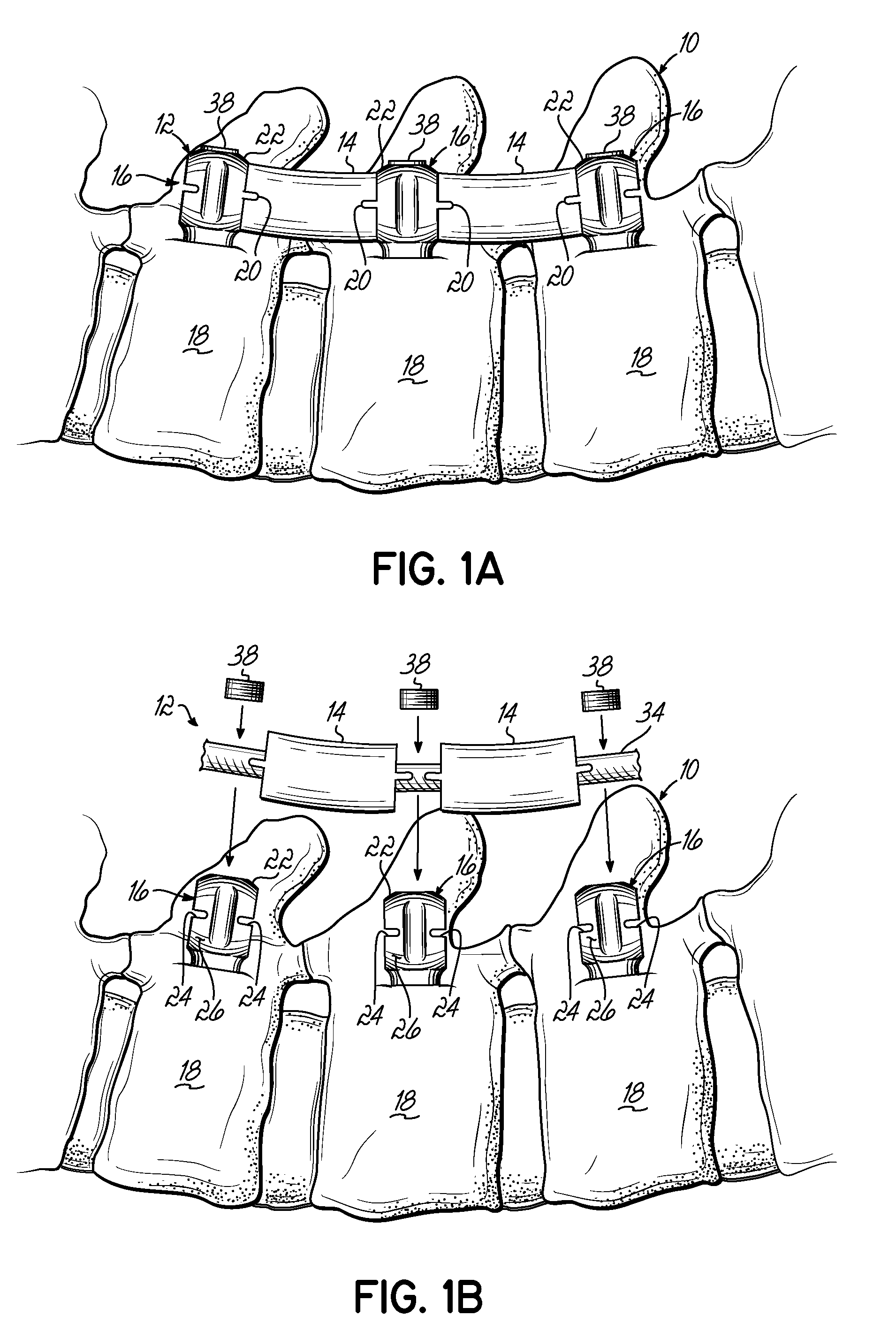 Pre-Curved Flexible Member For Providing Dynamic Stability To A Spine