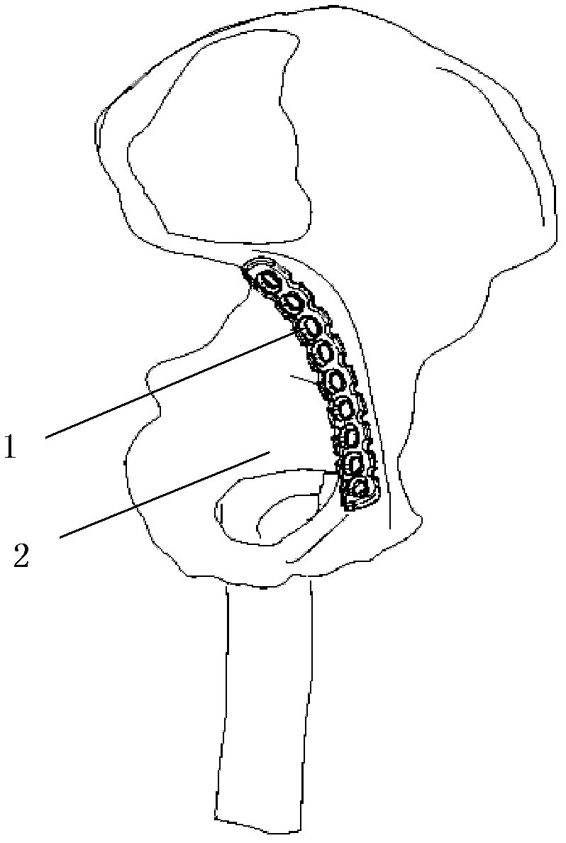 Pelvis arcuate line lower edge anatomic bone fracture plate