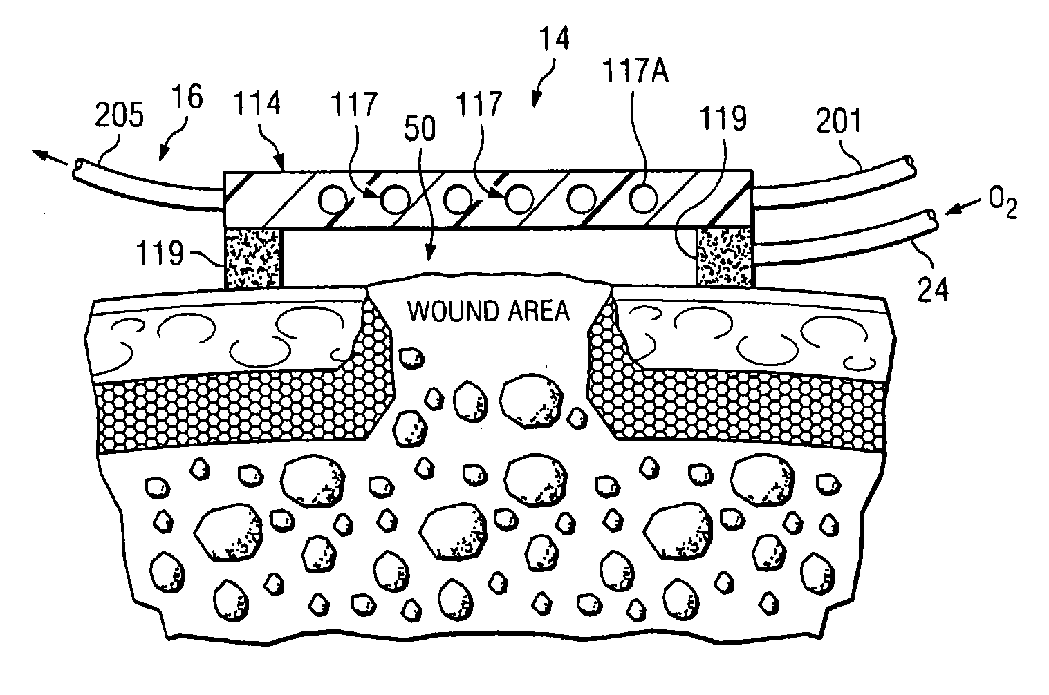 Method of and system for thermally augmented wound care oxygenation