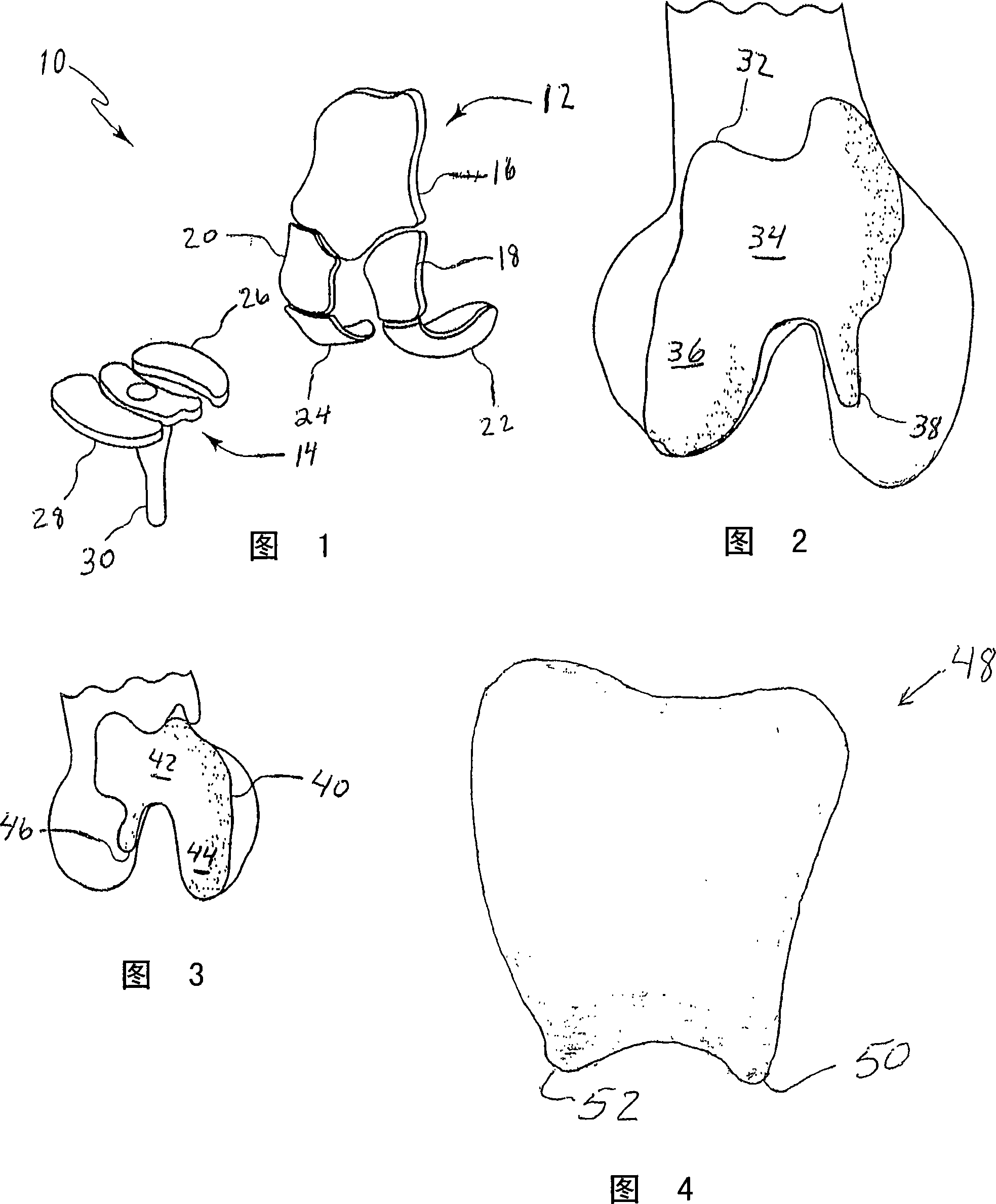 Systems and methods for compartmental replacement in a knee