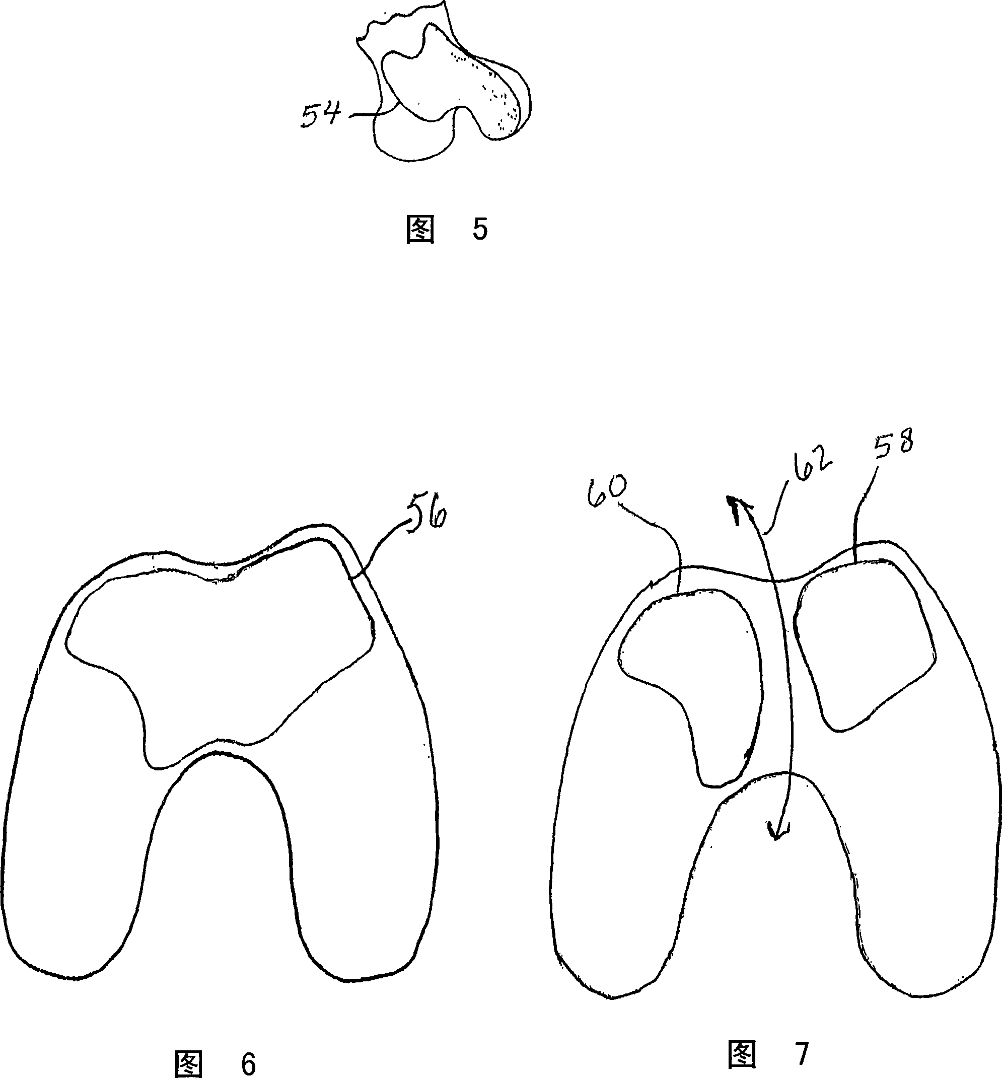 Systems and methods for compartmental replacement in a knee