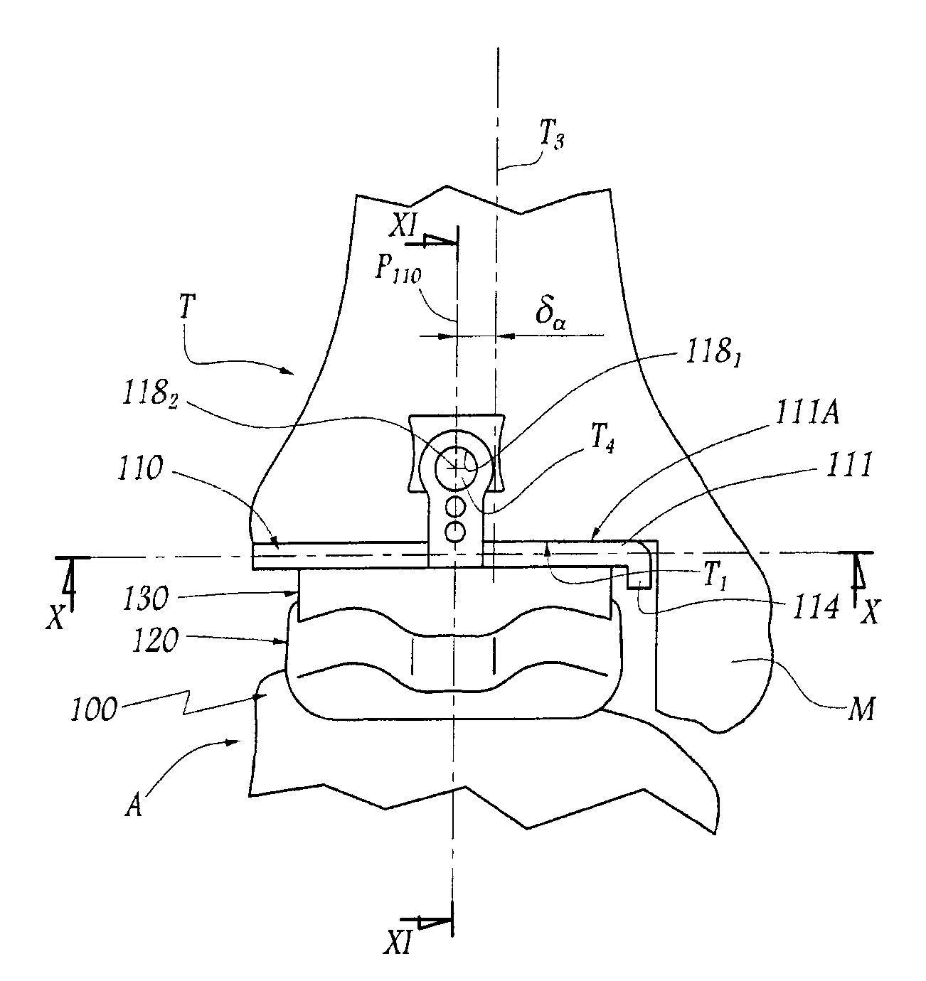 Surgical instrumentation kit for inserting an ankle prosthesis