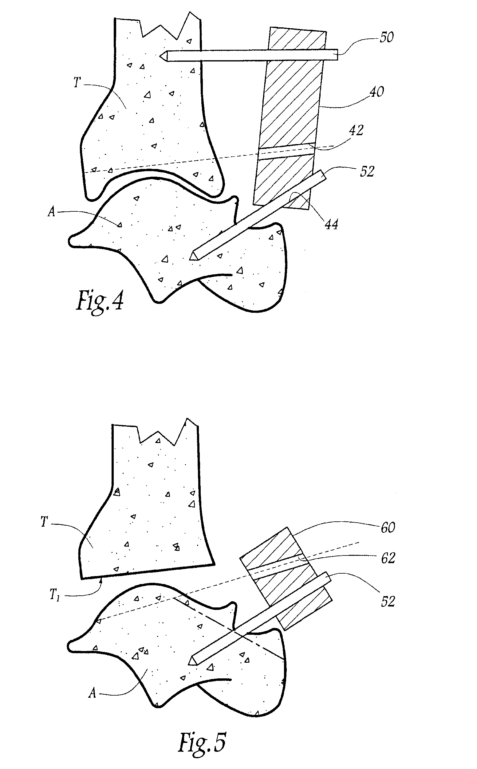 Surgical instrumentation kit for inserting an ankle prosthesis