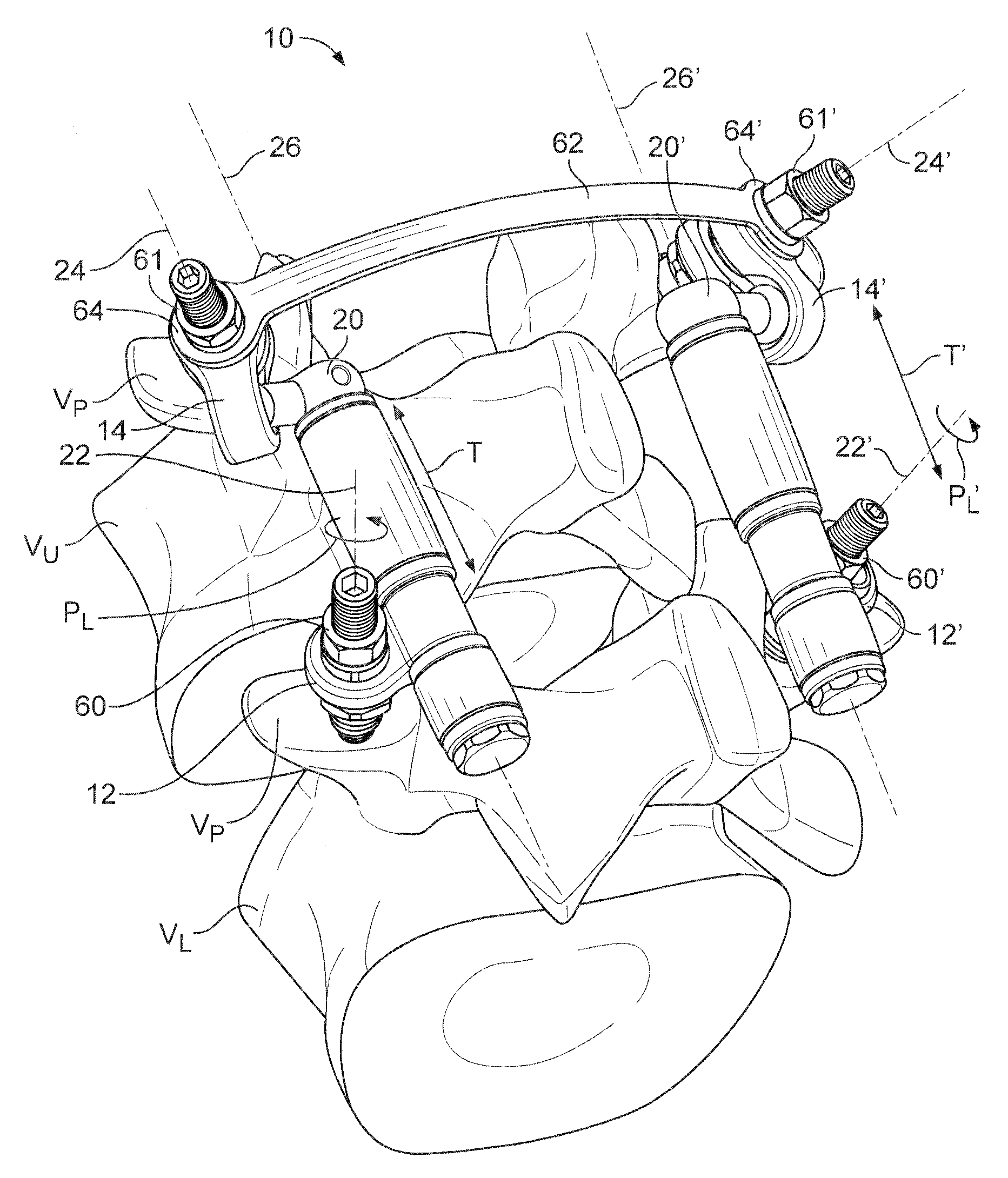 Posterior lumbar joint prosthesis