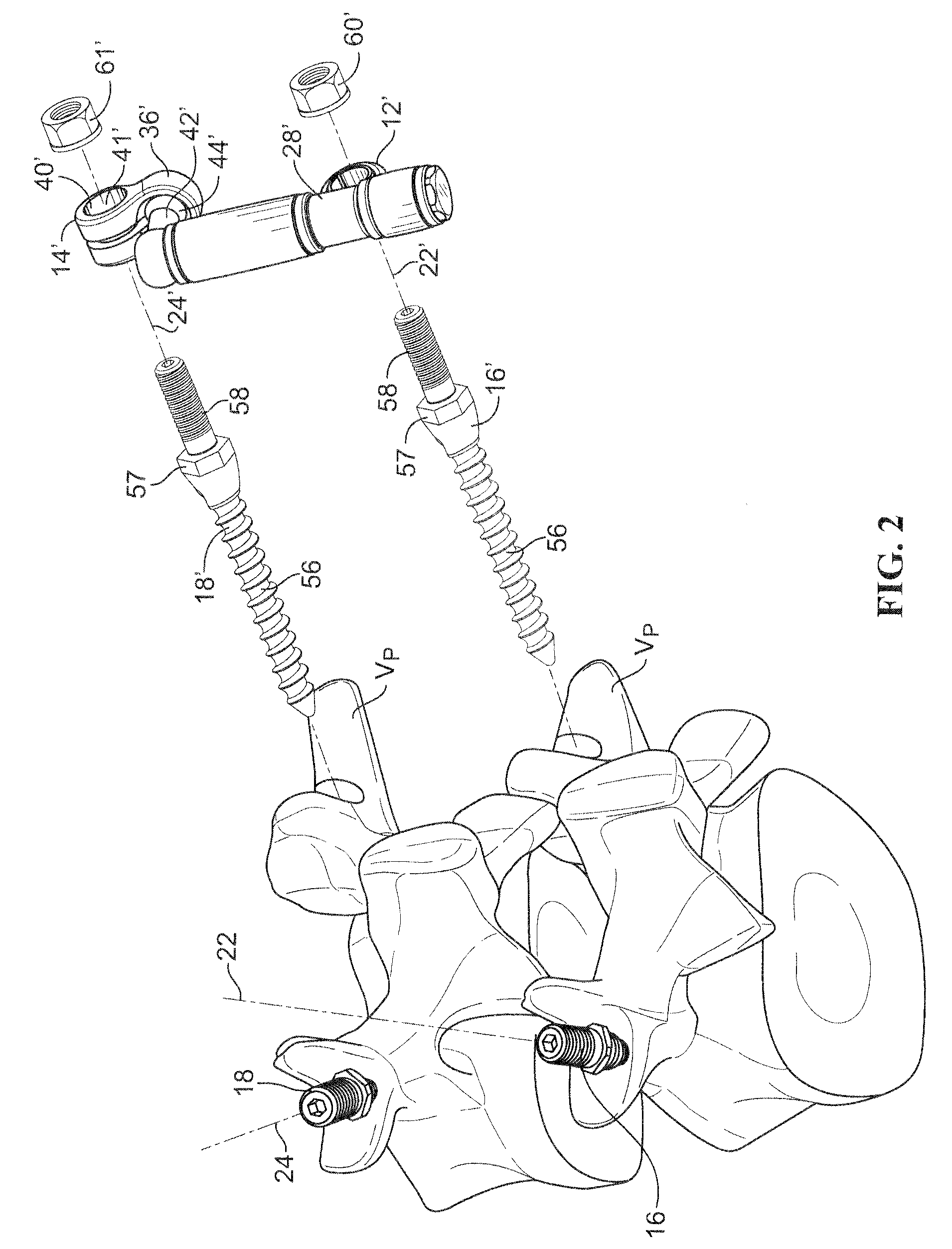 Posterior lumbar joint prosthesis