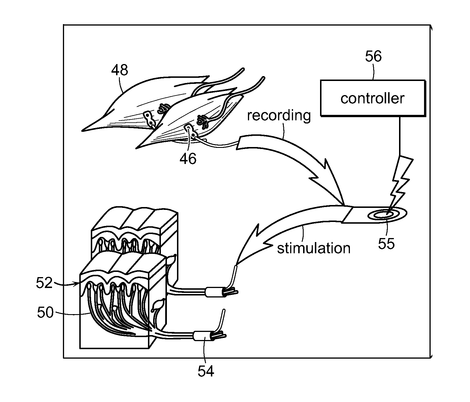 Peripheral Neural Interface Via Nerve Regeneration to Distal Tissues