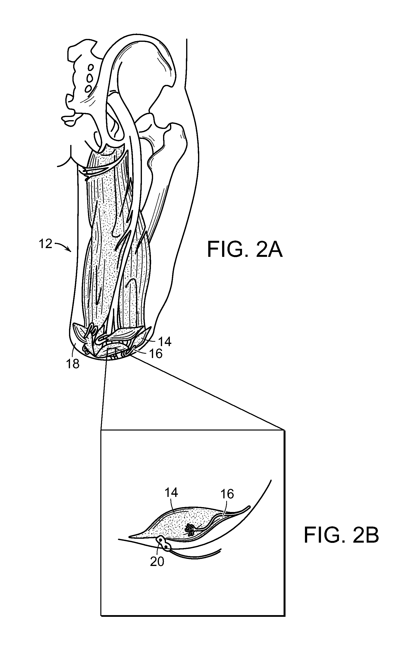 Peripheral Neural Interface Via Nerve Regeneration to Distal Tissues