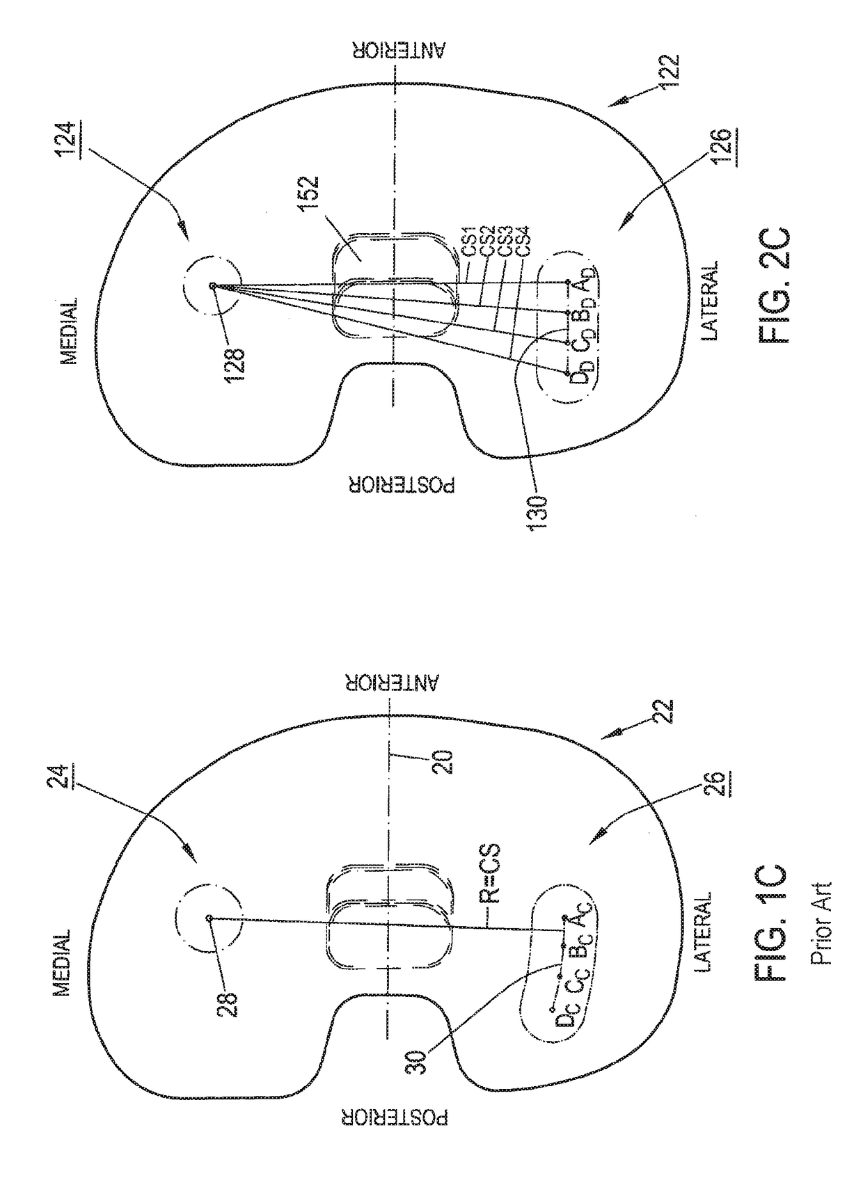 Femoral knee prosthesis with diverging lateral condyle