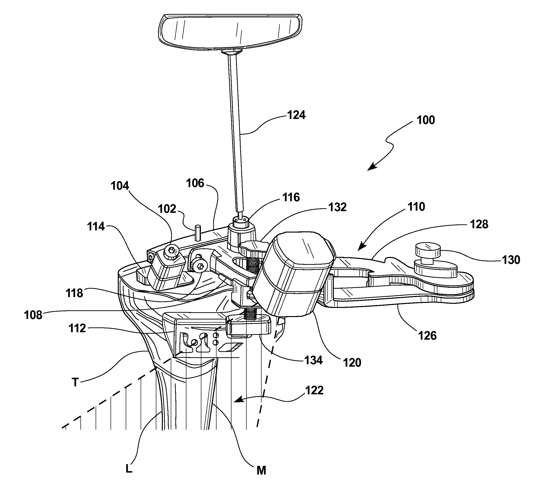 Knee arthroplasty apparatus and method