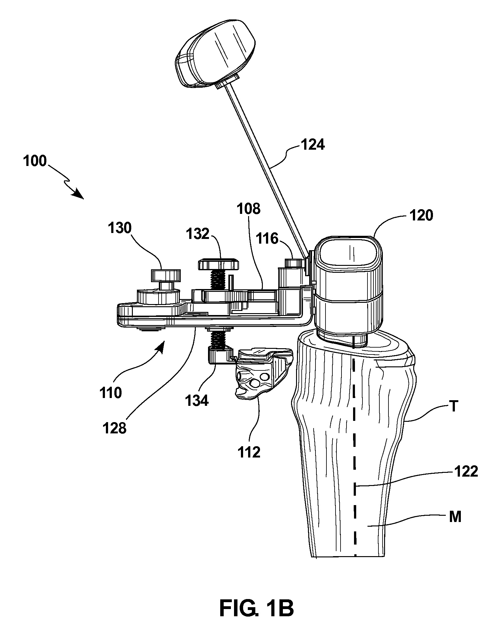 Knee arthroplasty apparatus and method