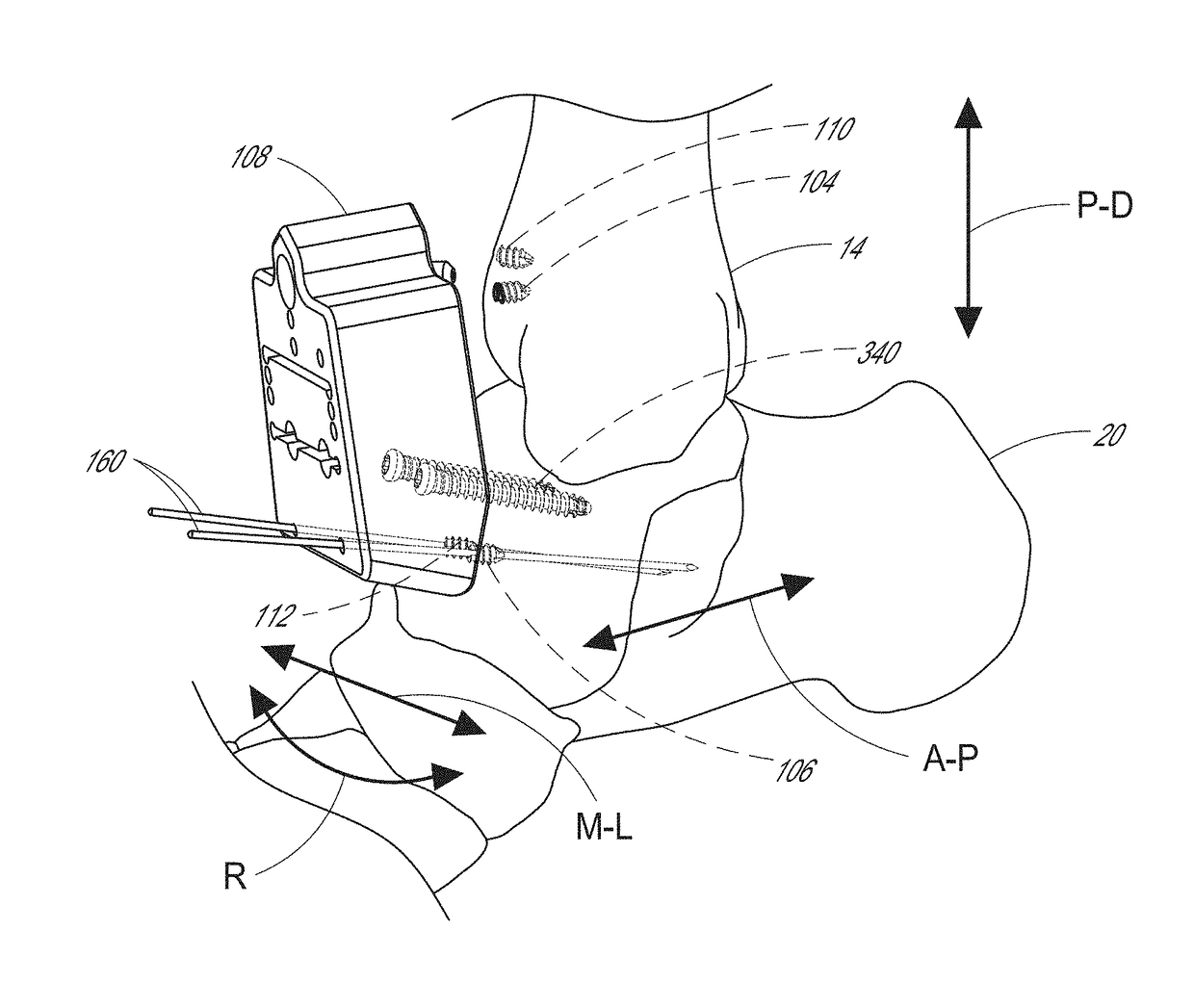 Patient specific instruments and methods for joint prosthesis