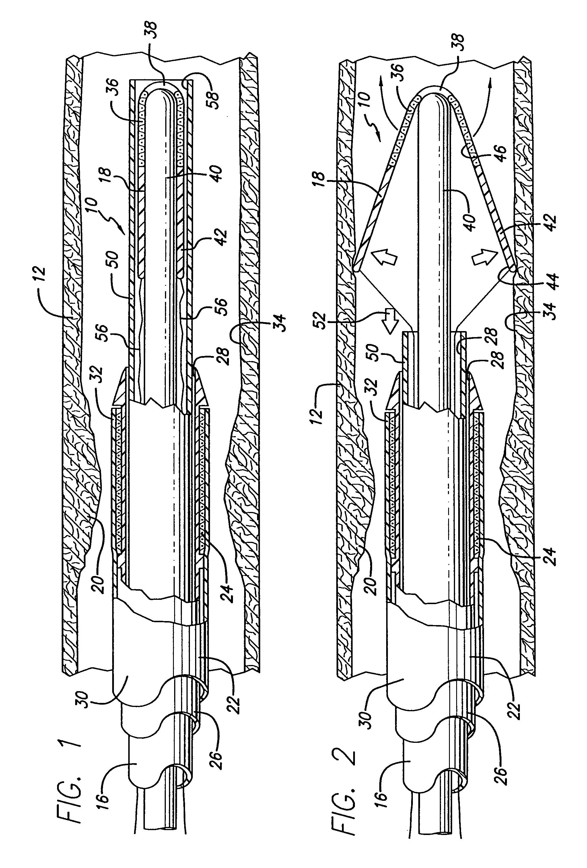 Device for, and method of, blocking emboli in vessels such as blood arteries