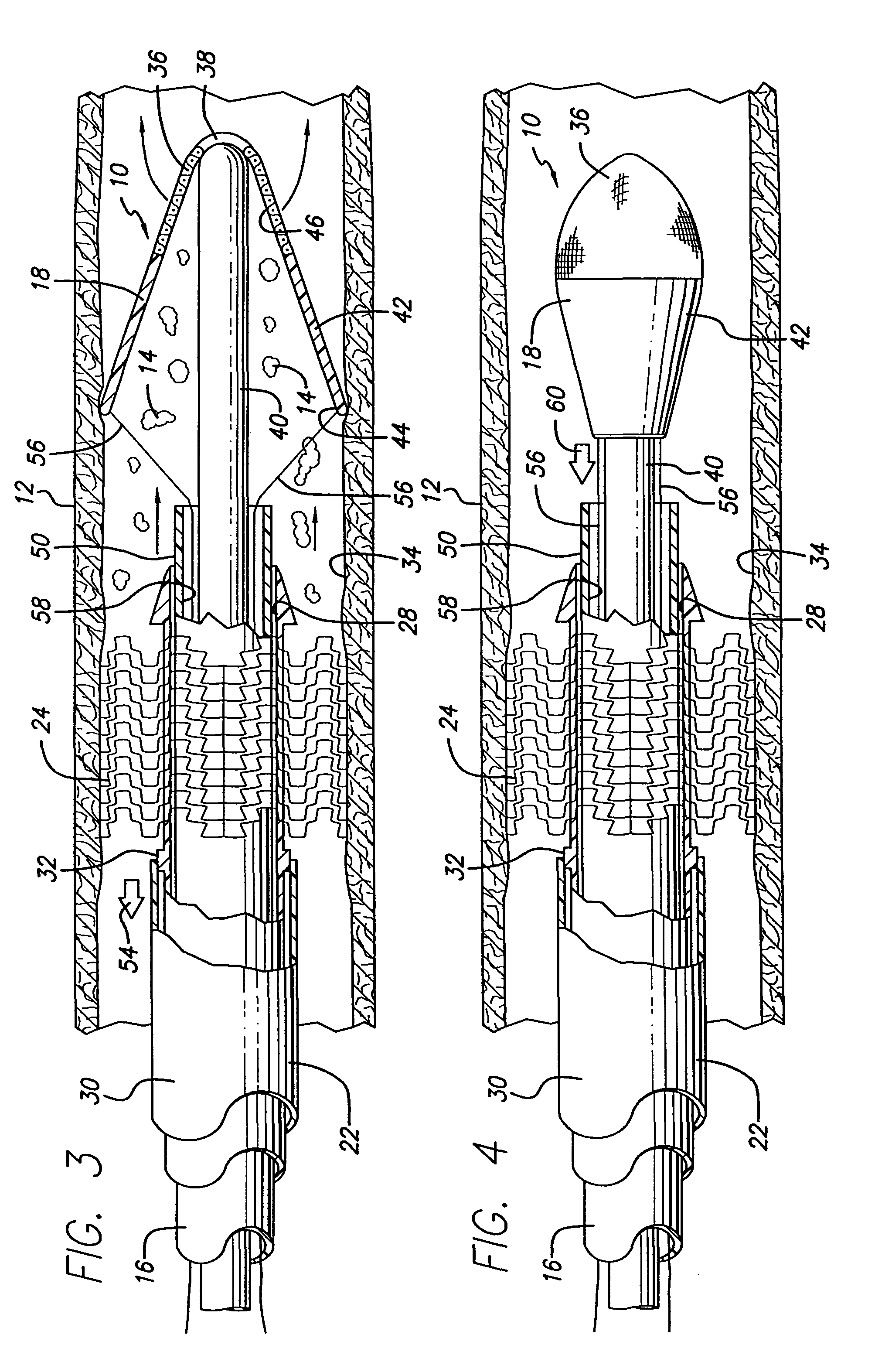 Device for, and method of, blocking emboli in vessels such as blood arteries