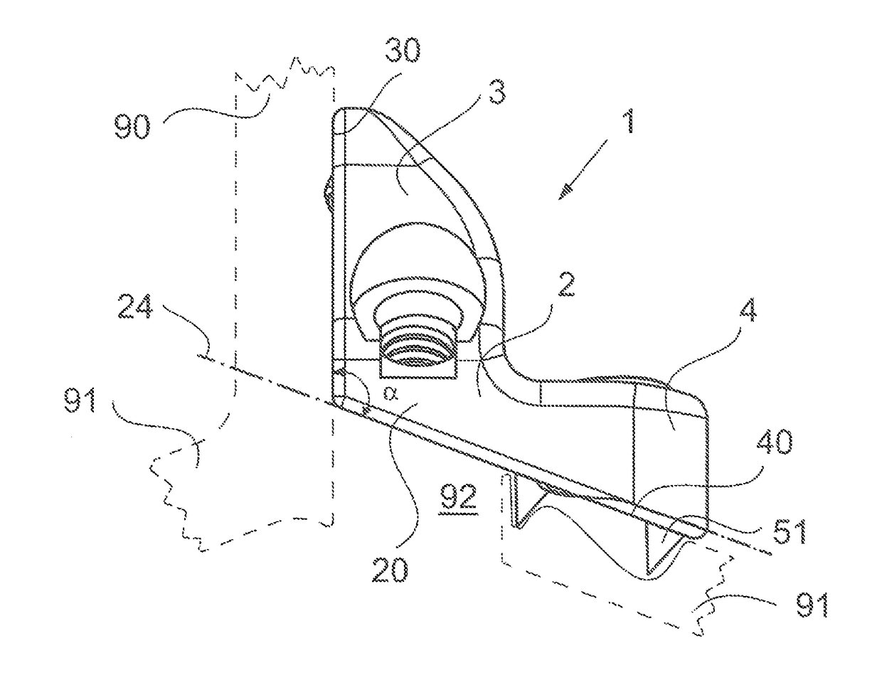 Reinforcement implant for lamina with a cantilever bridge part