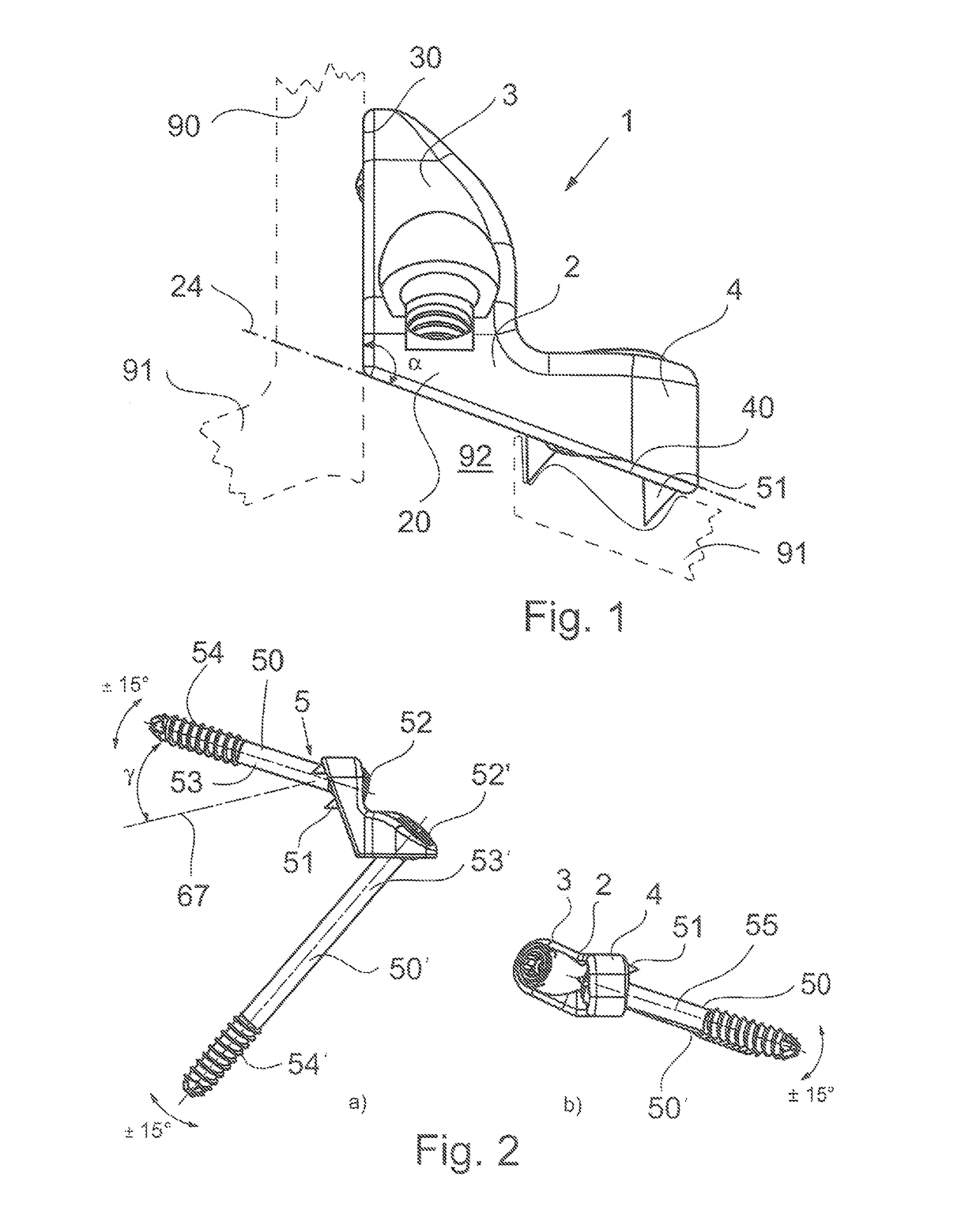 Reinforcement implant for lamina with a cantilever bridge part