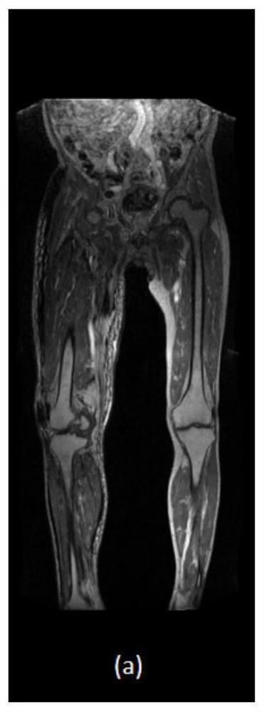 Deep learning-based lower limb deep vein thrombosis detection method, medium and terminal