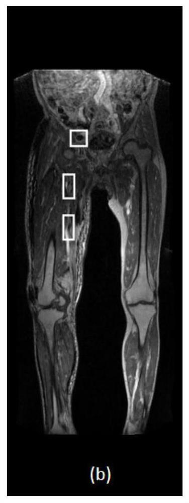 Deep learning-based lower limb deep vein thrombosis detection method, medium and terminal