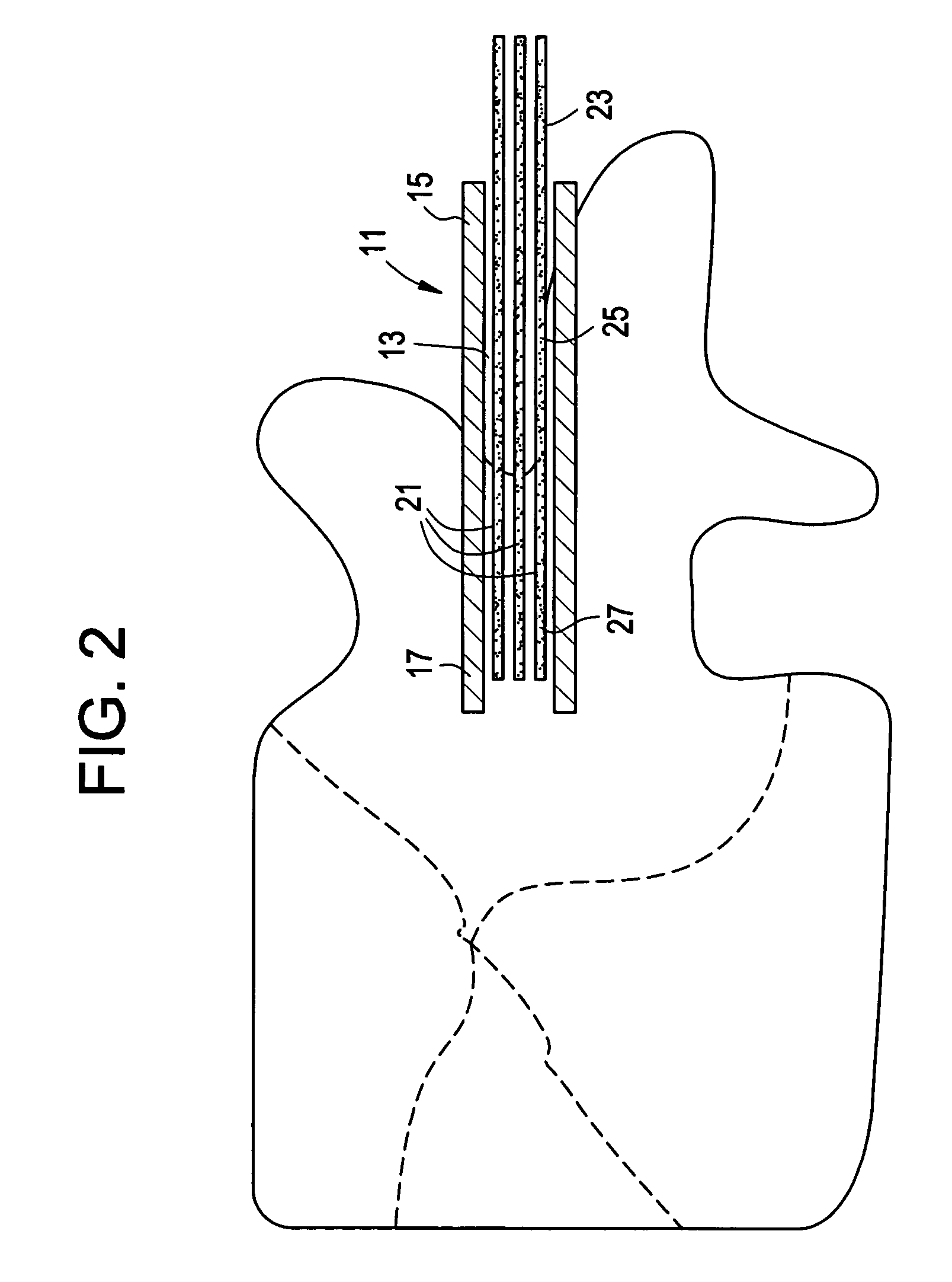 Tissue augmentation, stabilization and regeneration technique