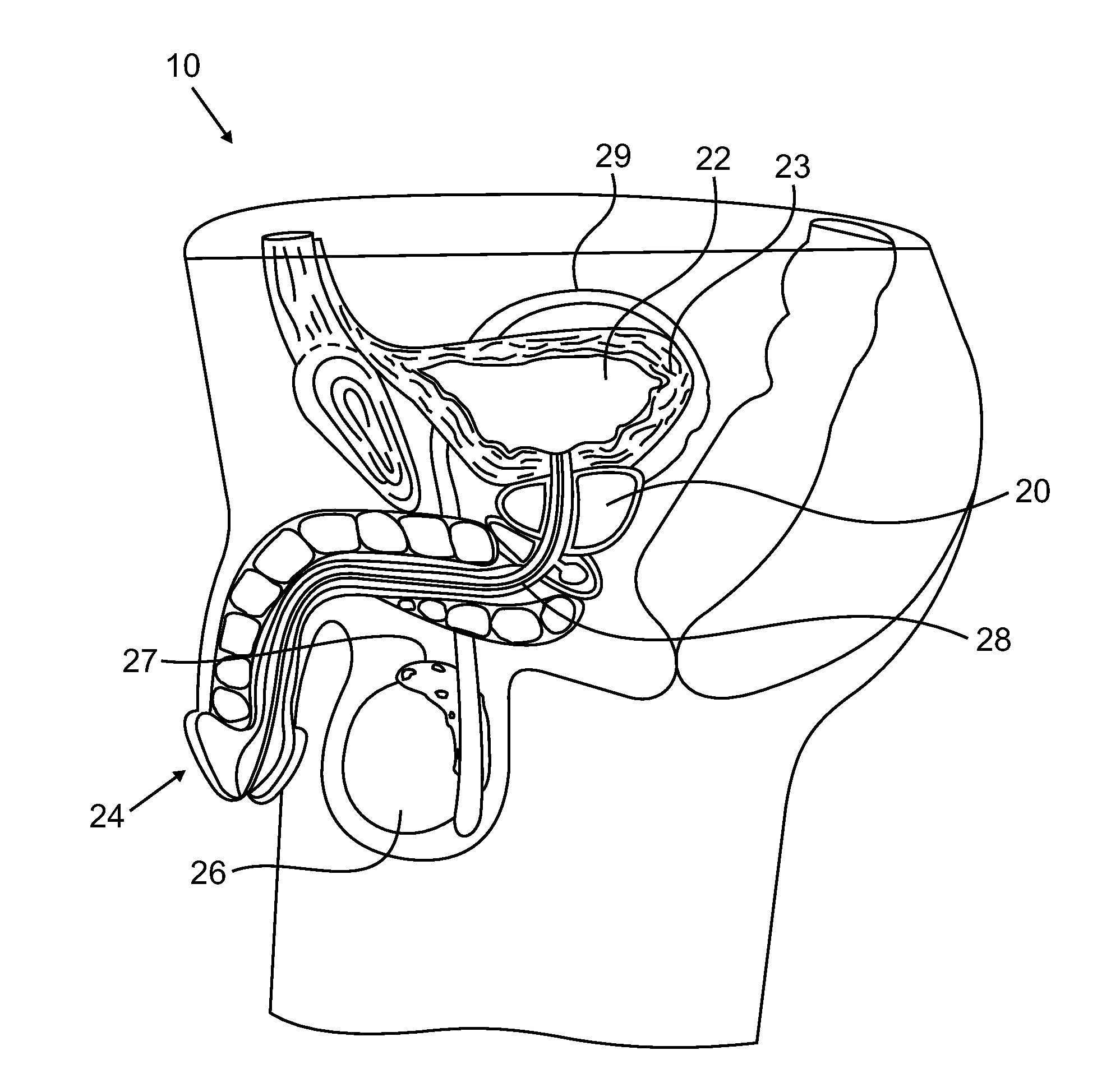 Urological medical devices for release of prostatically beneficial therapeutic agents