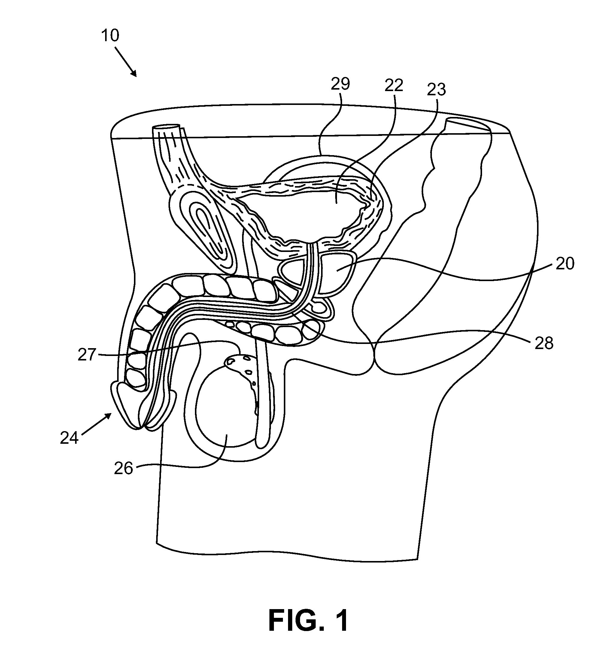 Urological medical devices for release of prostatically beneficial therapeutic agents