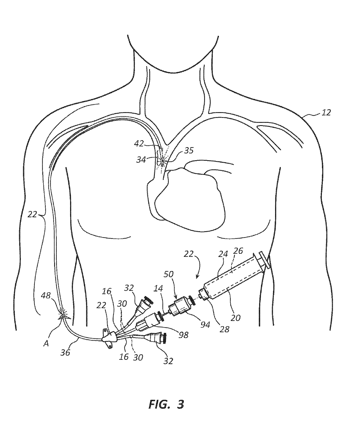 Methods and apparatus to deliver therapeutic, non-ultraviolet electromagnetic radiation versatilely via  a catheter residing in a body cavity