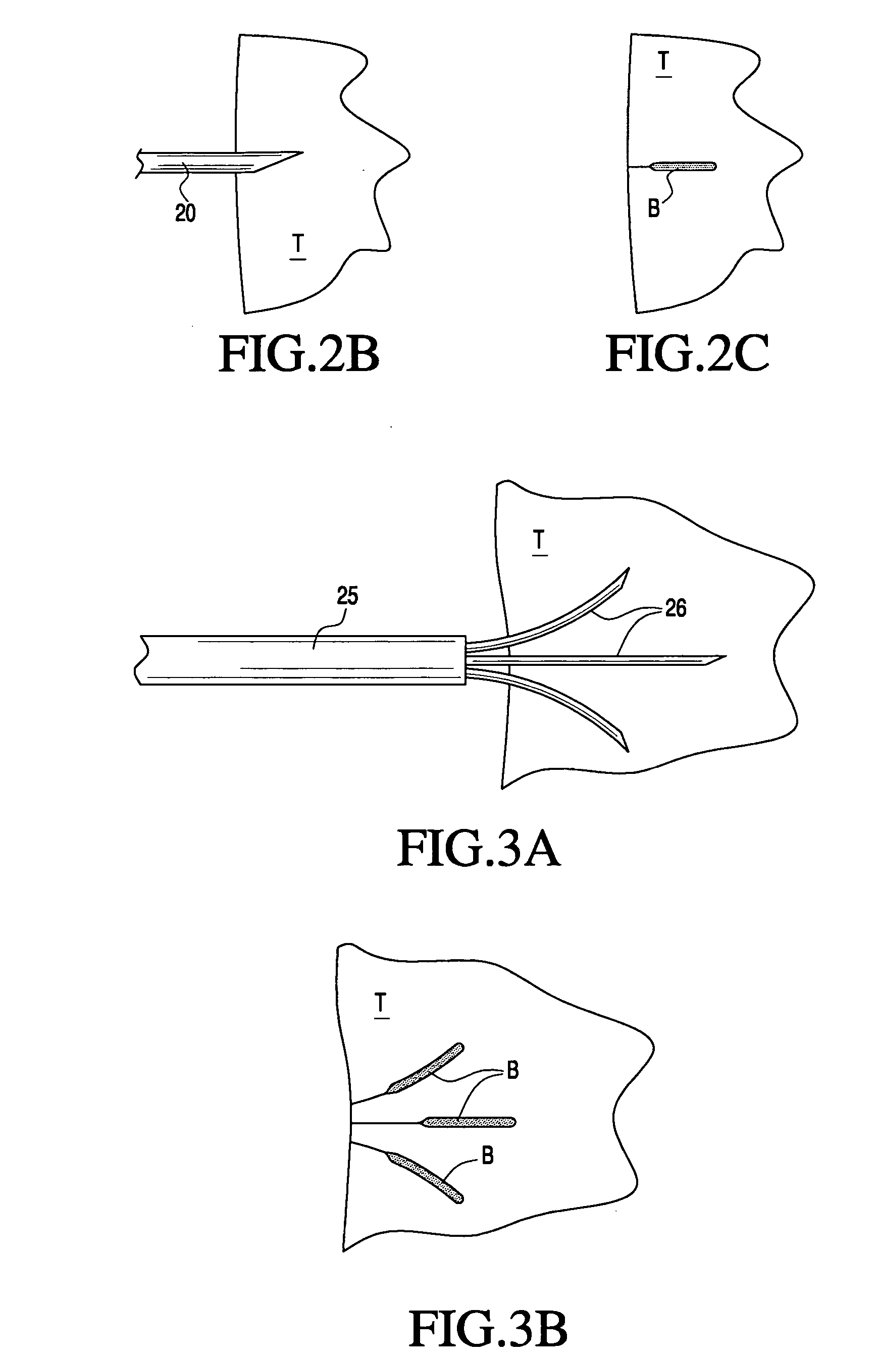 Apparatus and methods for treating tissue using passive injection systems