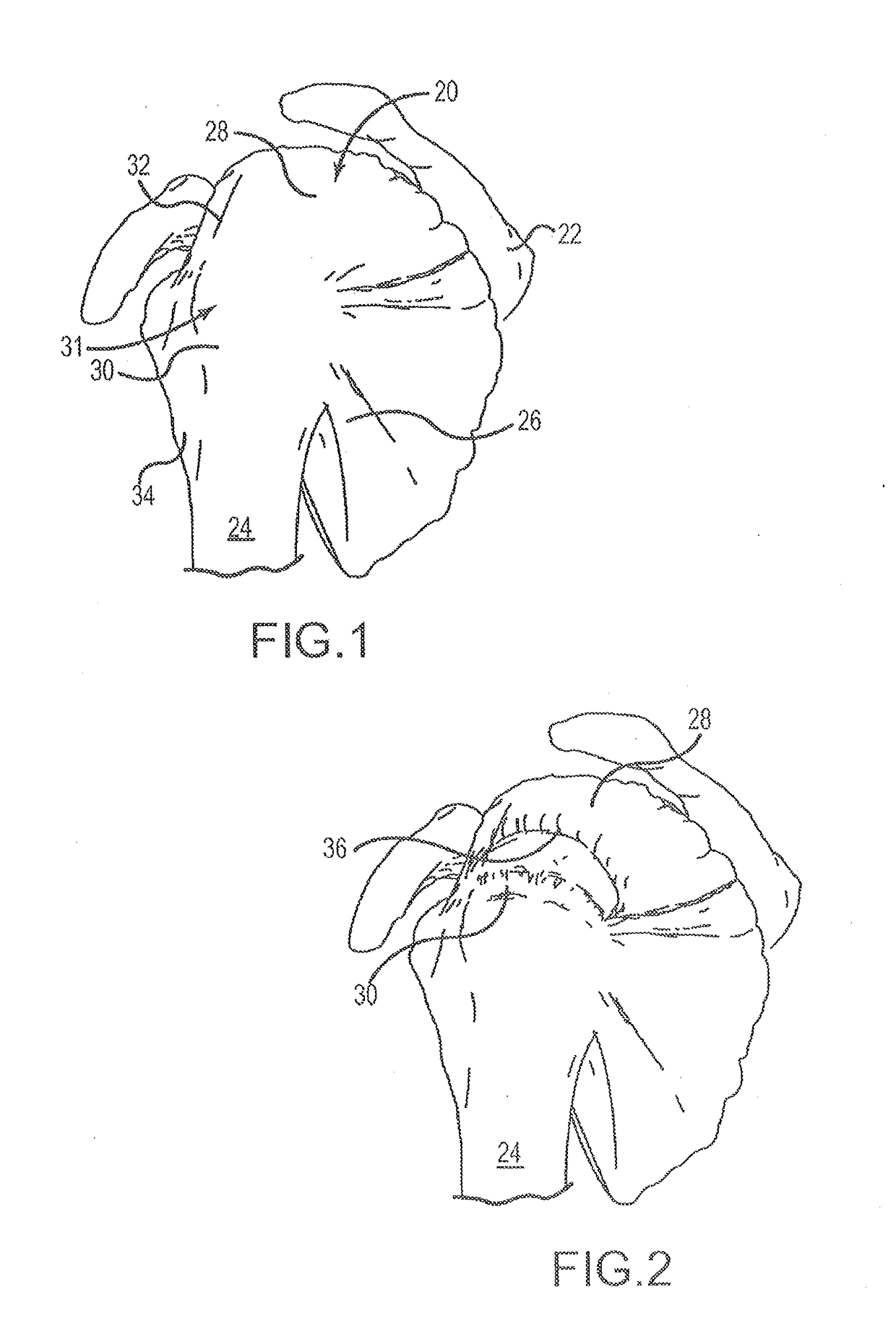 Suture sleeve patch and methods of delivery within an existing arthroscopic workflow