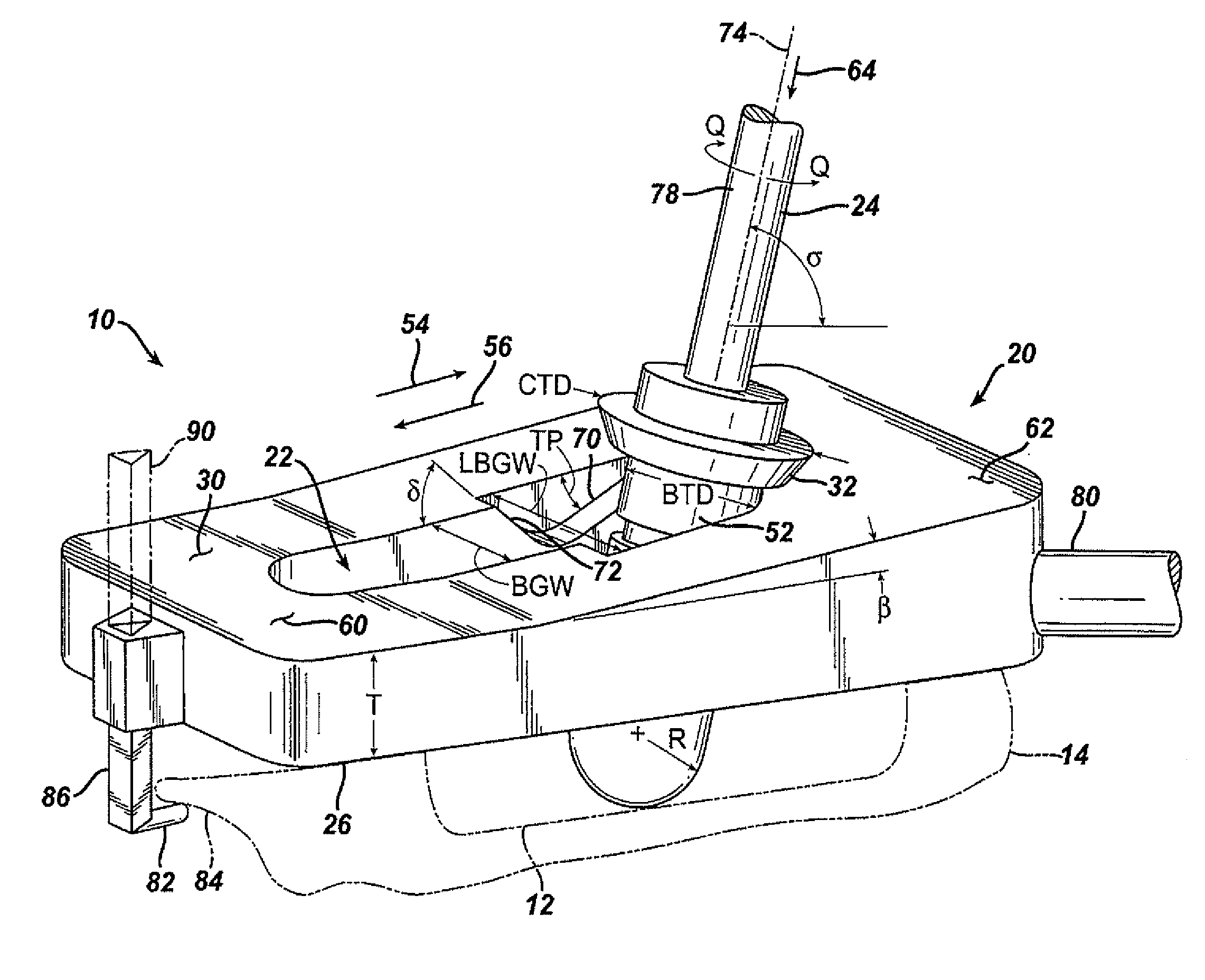 Method for Removal of Bone