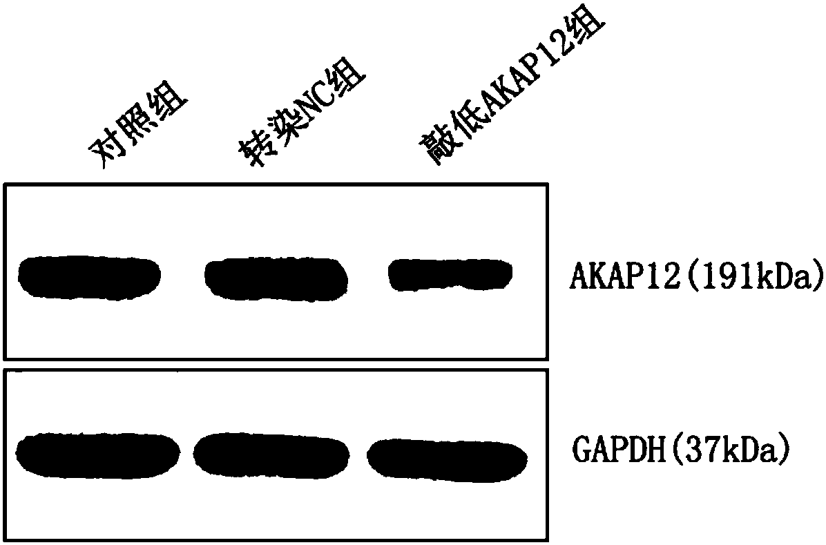 Application of reagent for inhibiting or down-regulating expression of AKAP12 gene in preparation of tumor radiotherapy sensitizing drugs