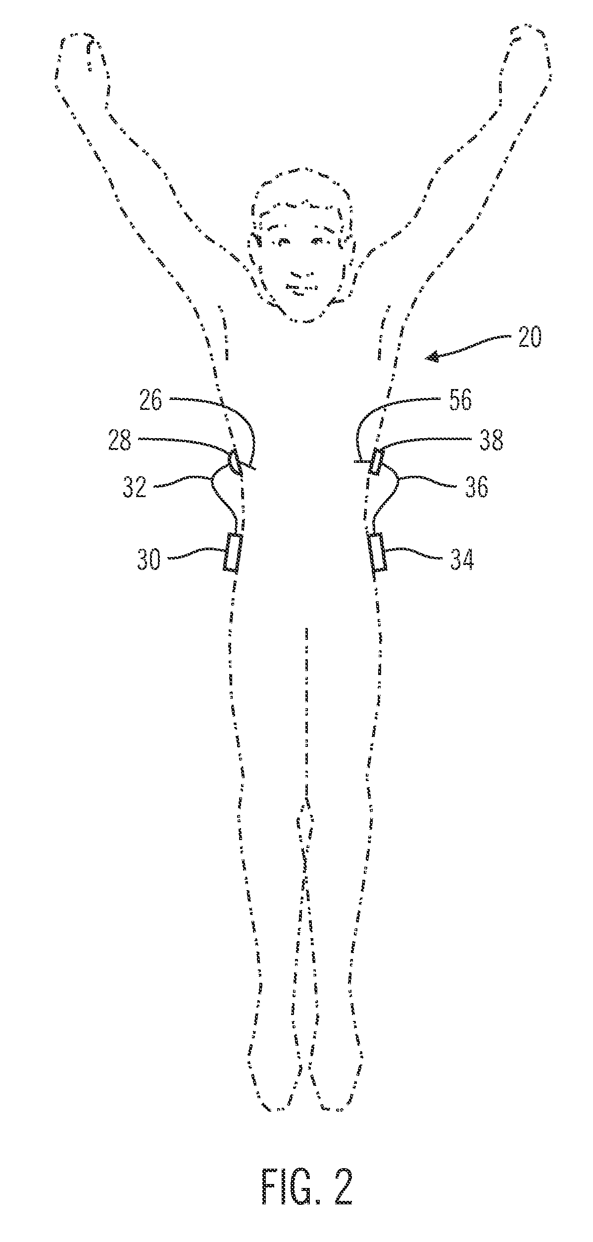 Insulin on board compensation for a closed-loop insulin infusion system