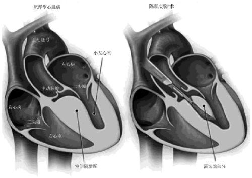 RF ablation catheter for treating hypertrophic cardiomyopathy