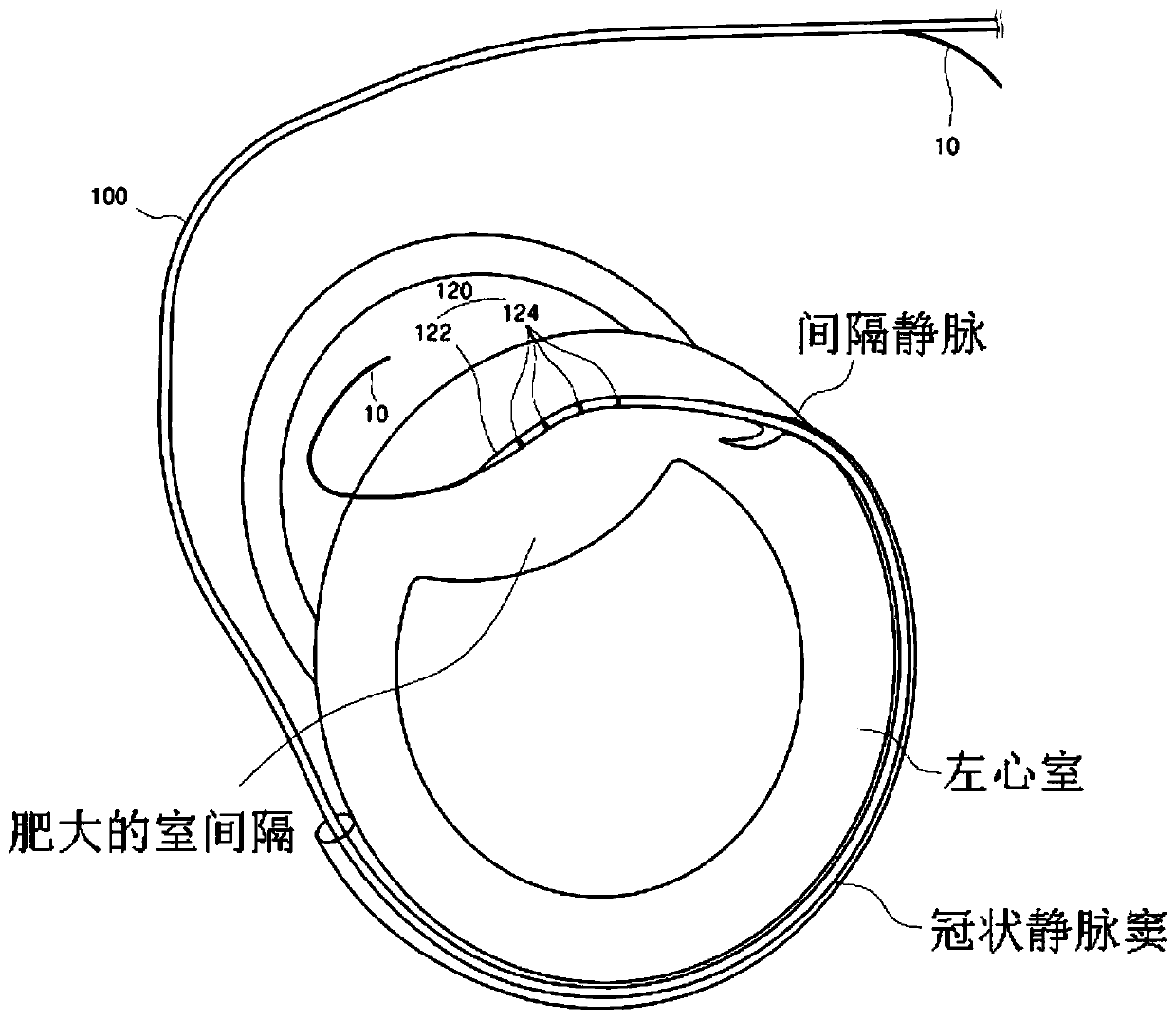 RF ablation catheter for treating hypertrophic cardiomyopathy